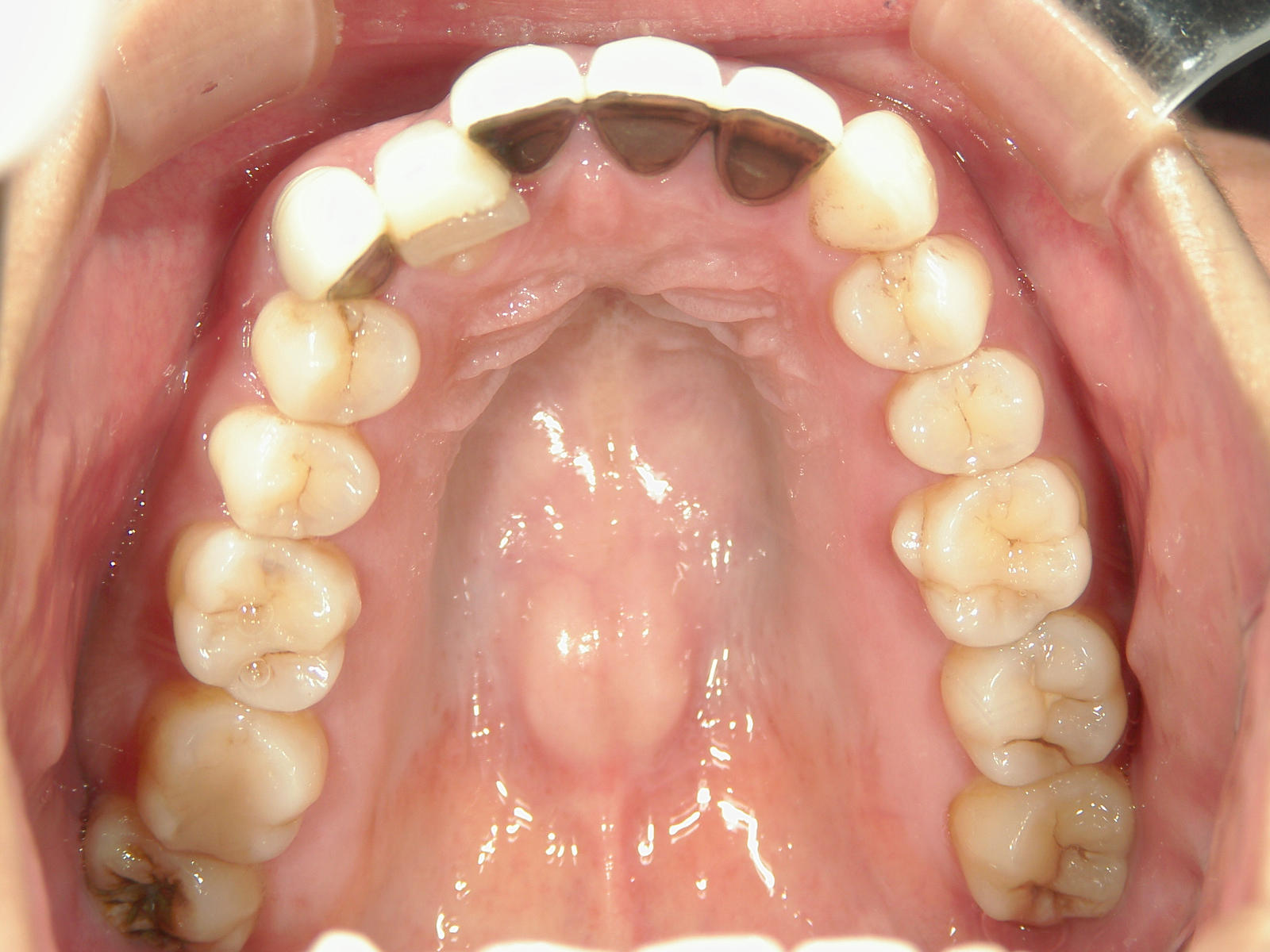全顎ワイヤー矯正　症例（82）
