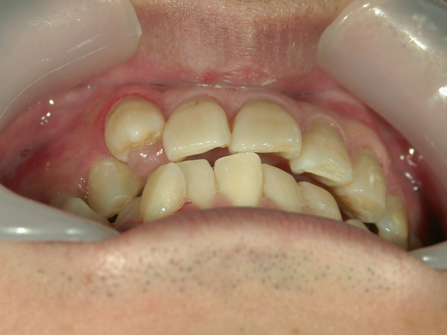 全顎ワイヤー矯正　症例（83）