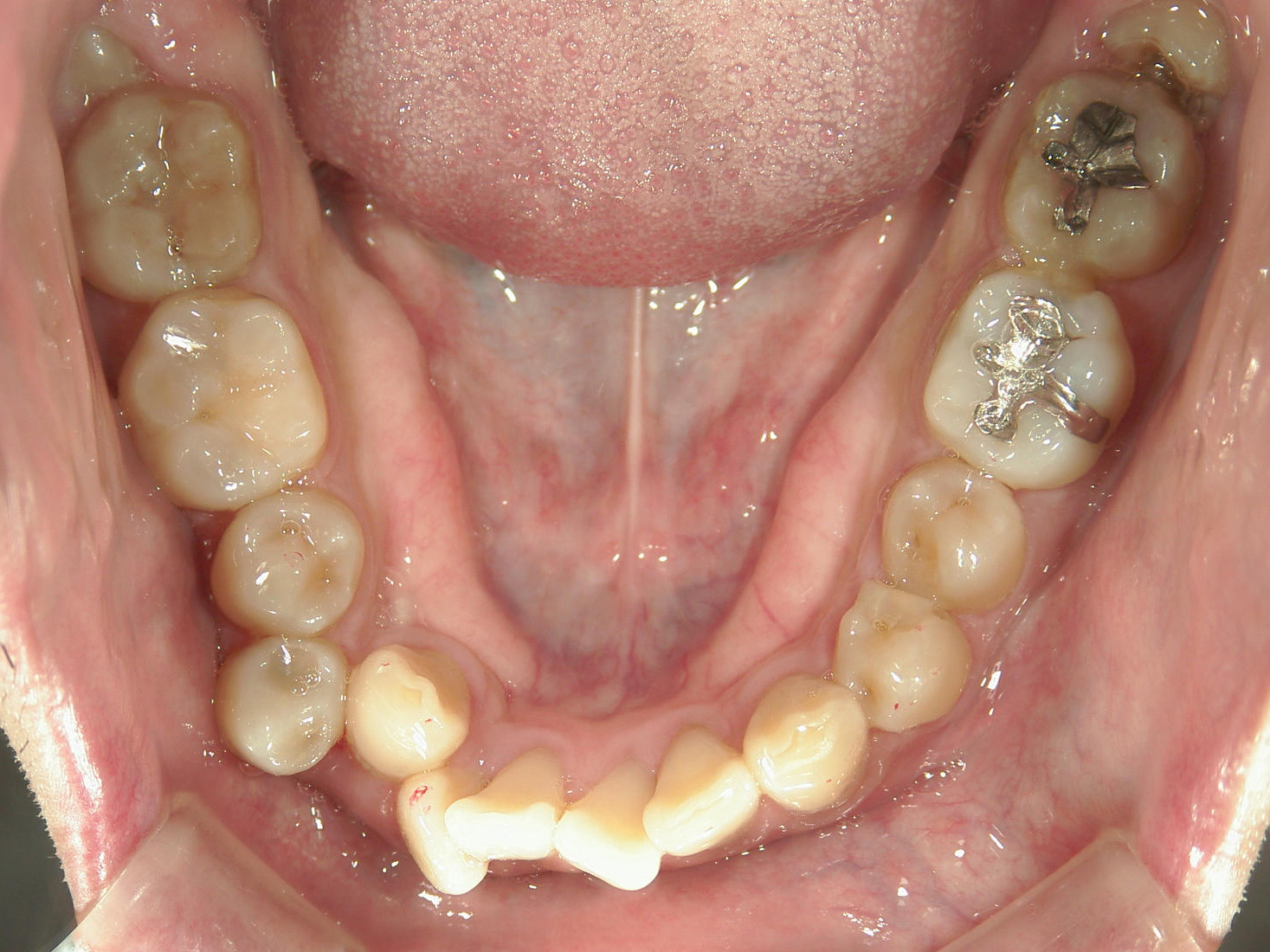 全顎ワイヤー矯正　症例（83）