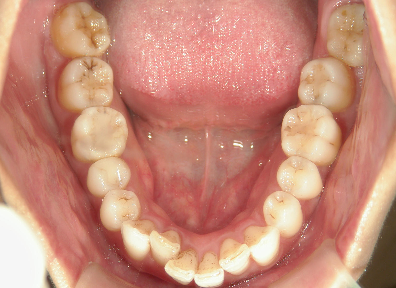 全顎ワイヤー矯正　症例（82）