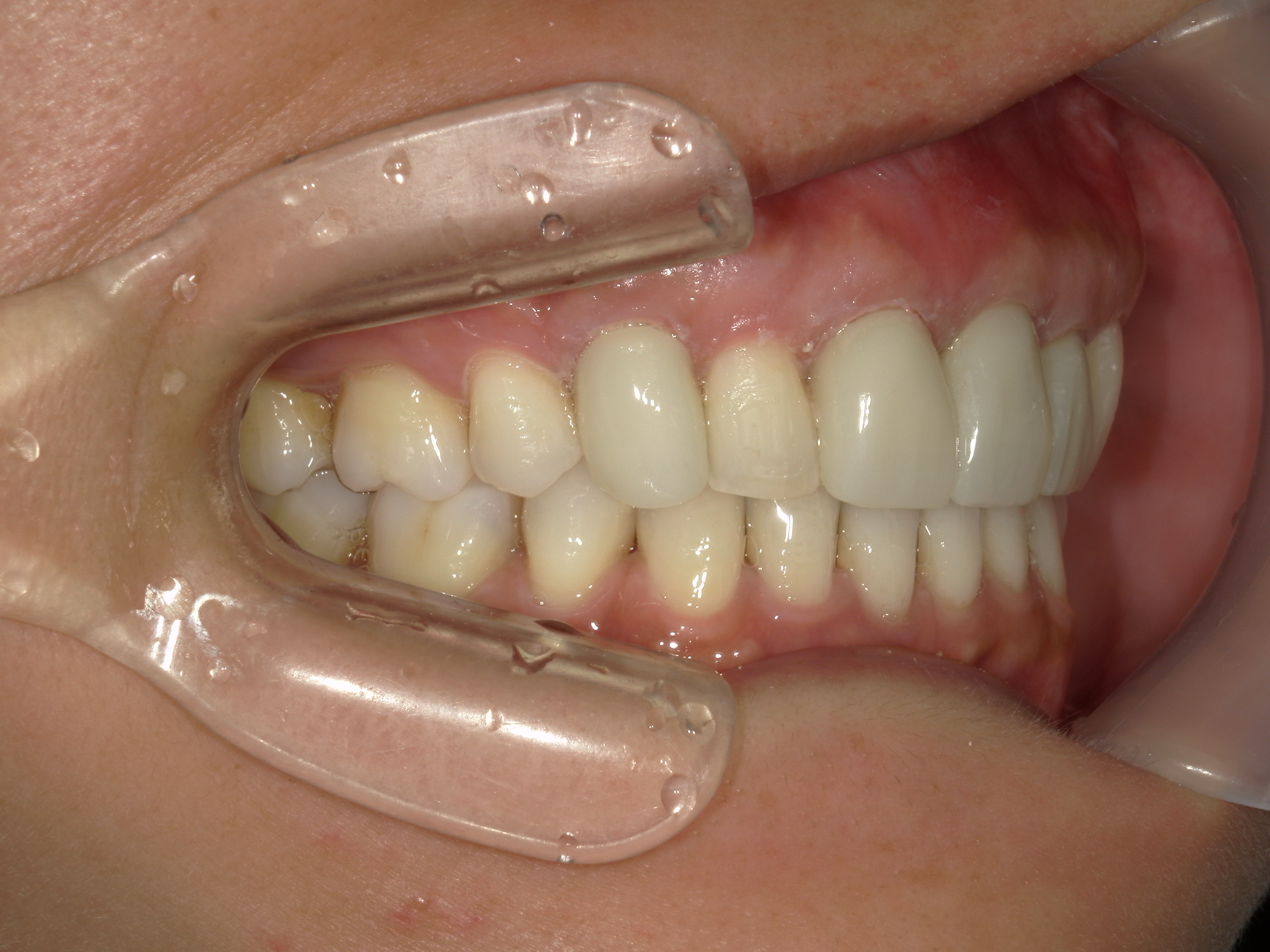 全顎ワイヤー矯正　症例（82）