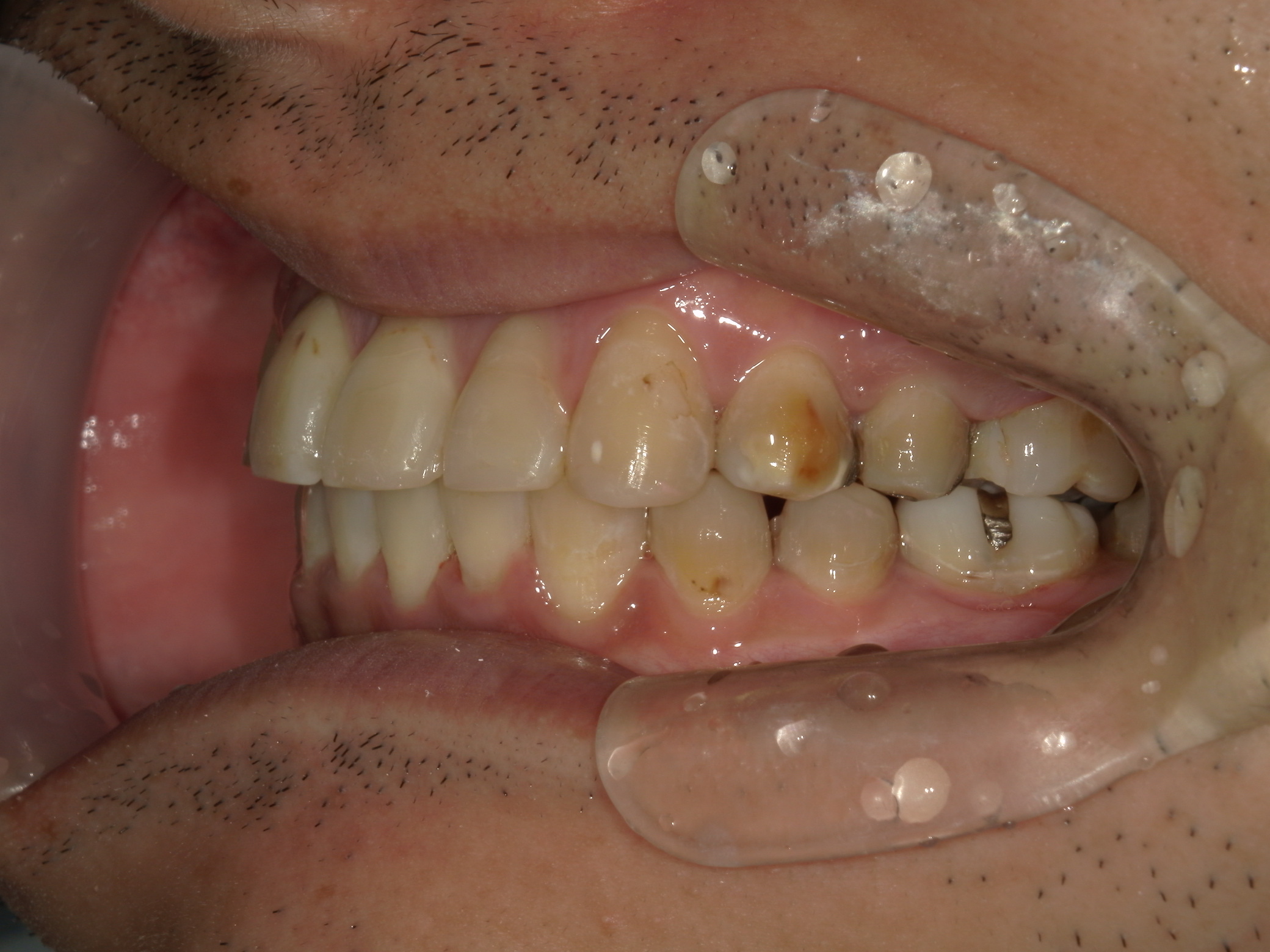 全顎ワイヤー矯正　症例（83）