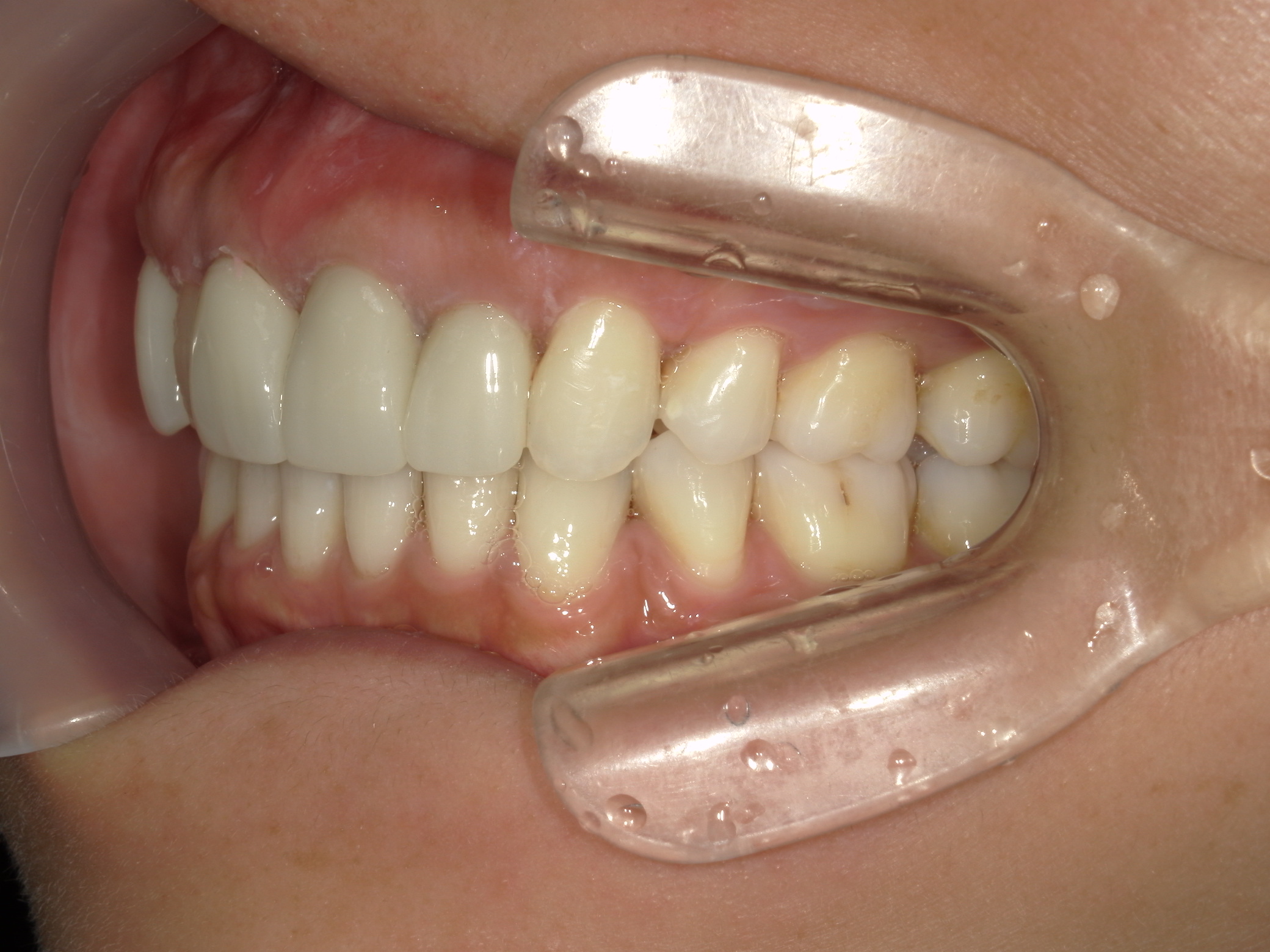 全顎ワイヤー矯正　症例（82）