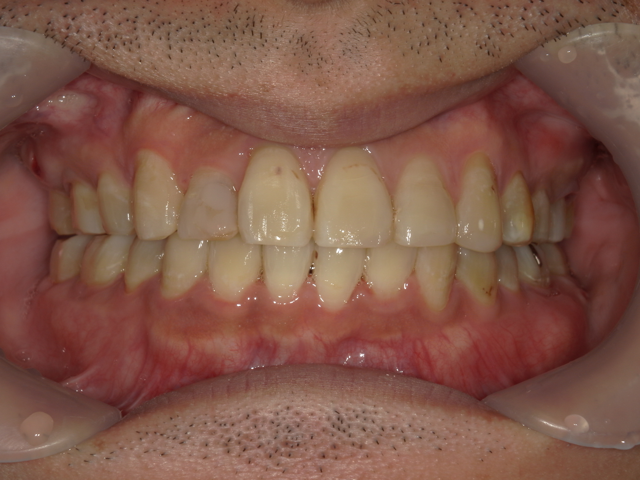 全顎ワイヤー矯正　症例（83）