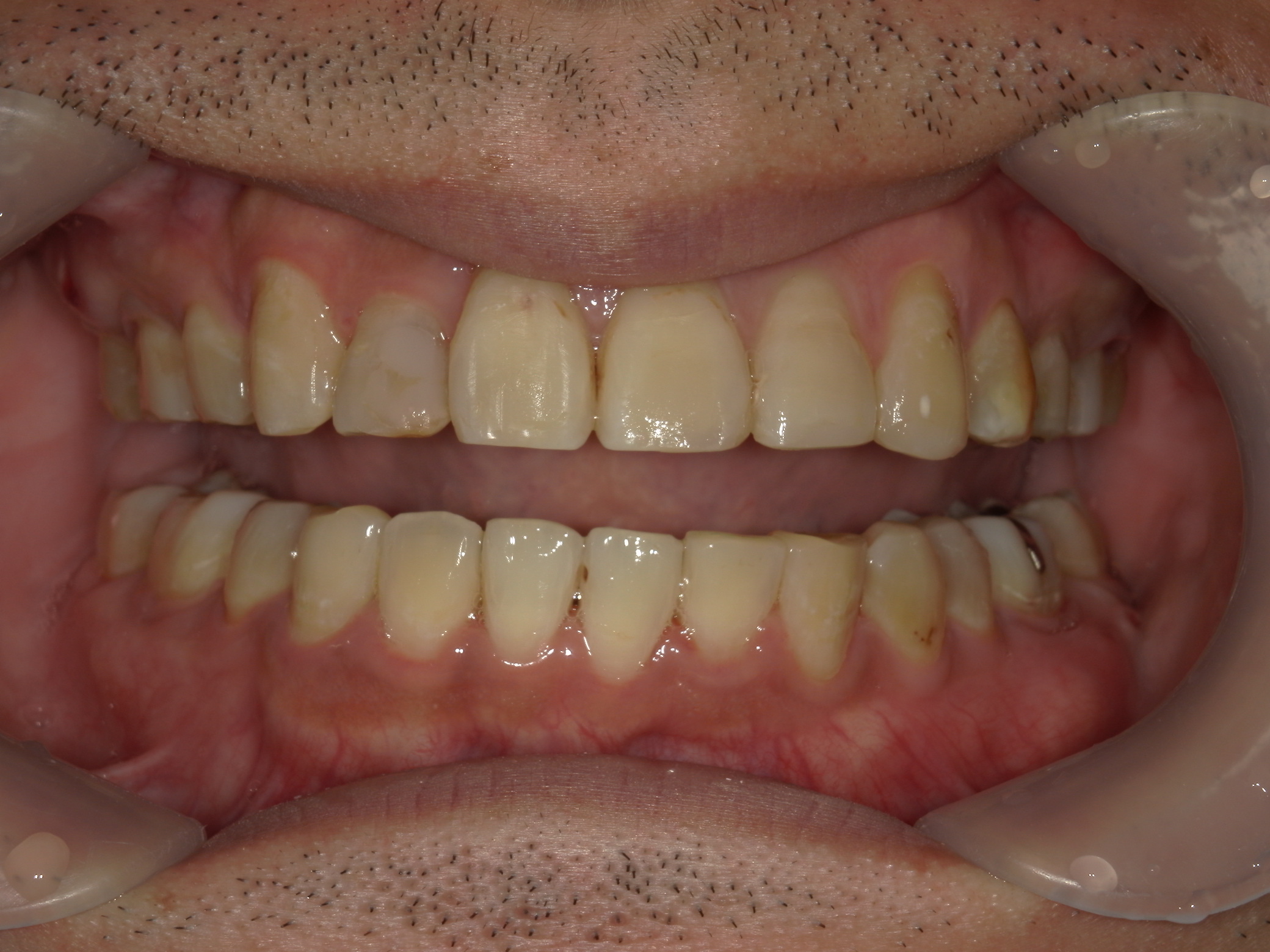 全顎ワイヤー矯正　症例（83）