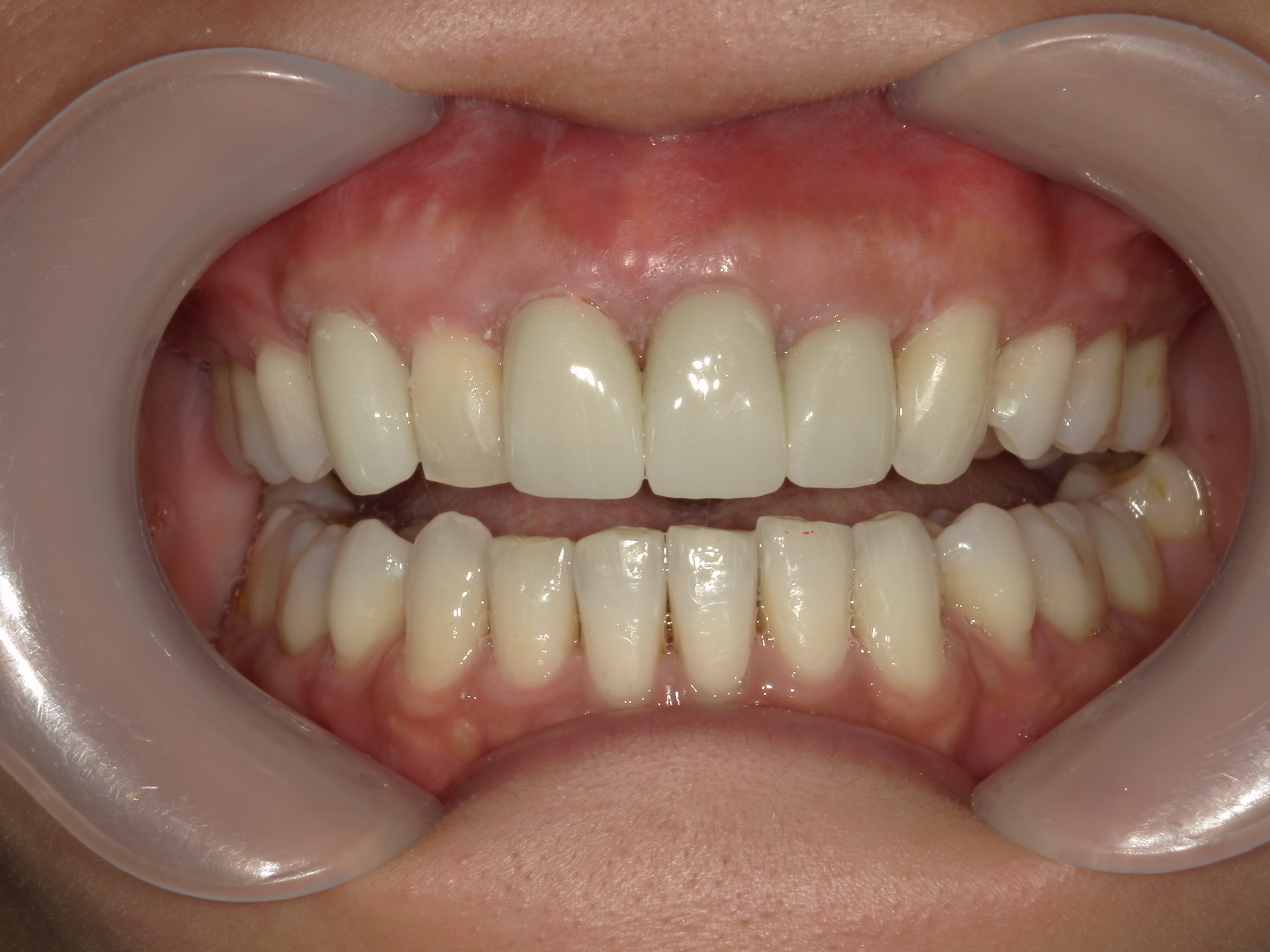 全顎ワイヤー矯正　症例（82）