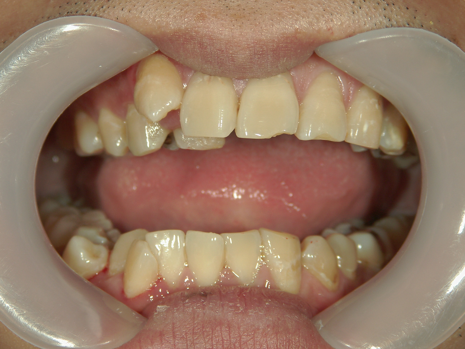 全顎ワイヤー矯正　症例（83）