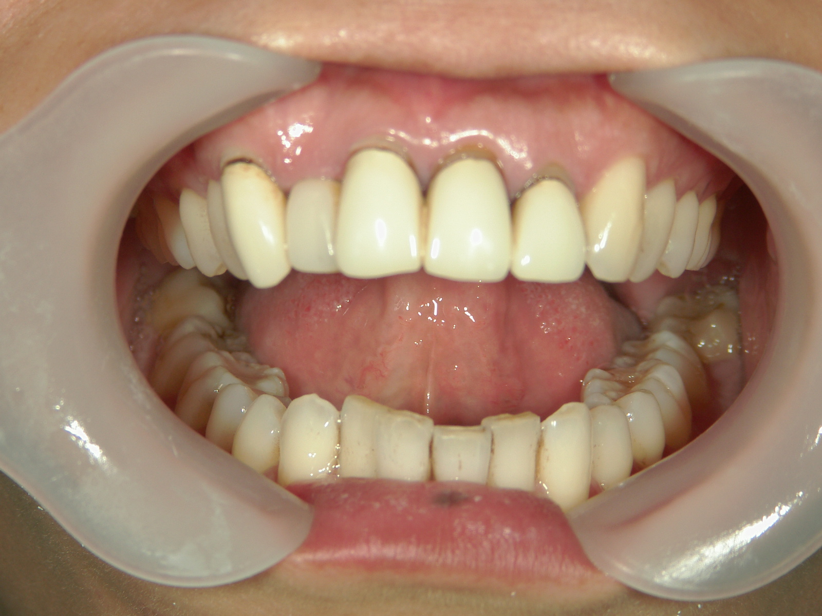 全顎ワイヤー矯正　症例（82）