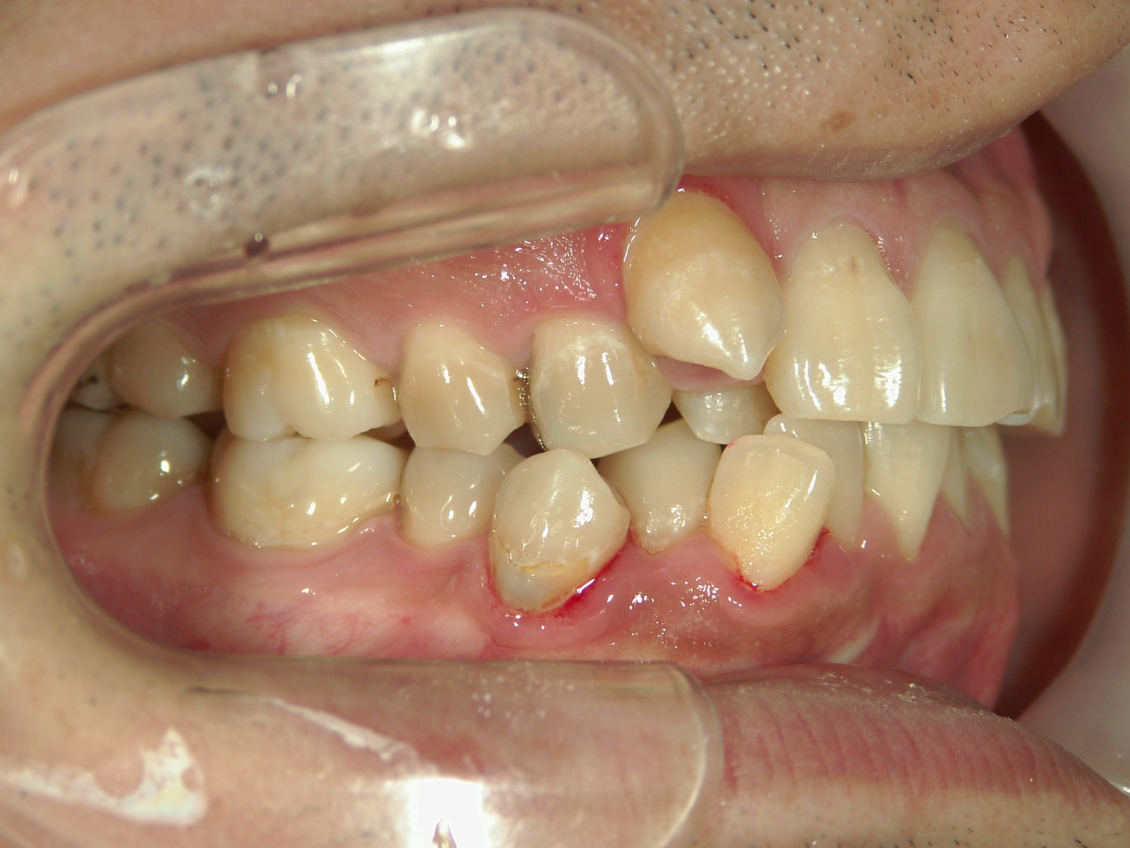 全顎ワイヤー矯正　症例（83）