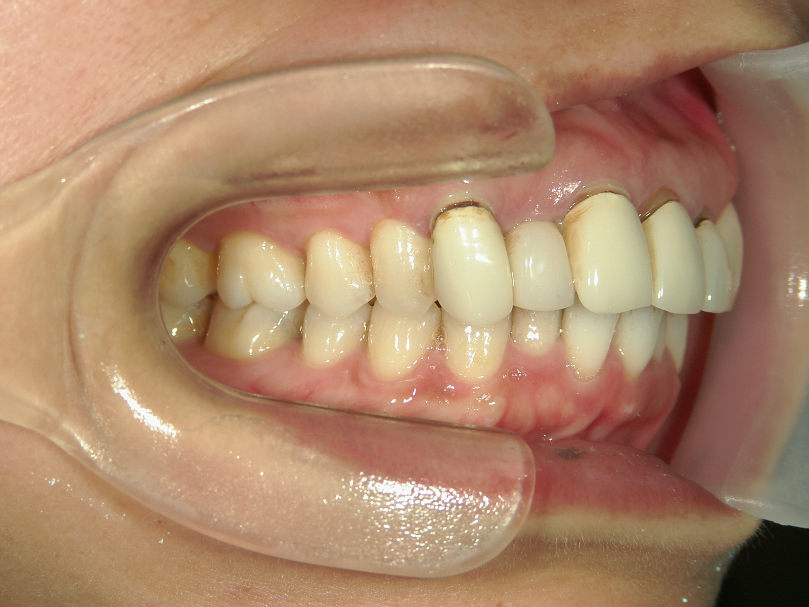 全顎ワイヤー矯正　症例（82）