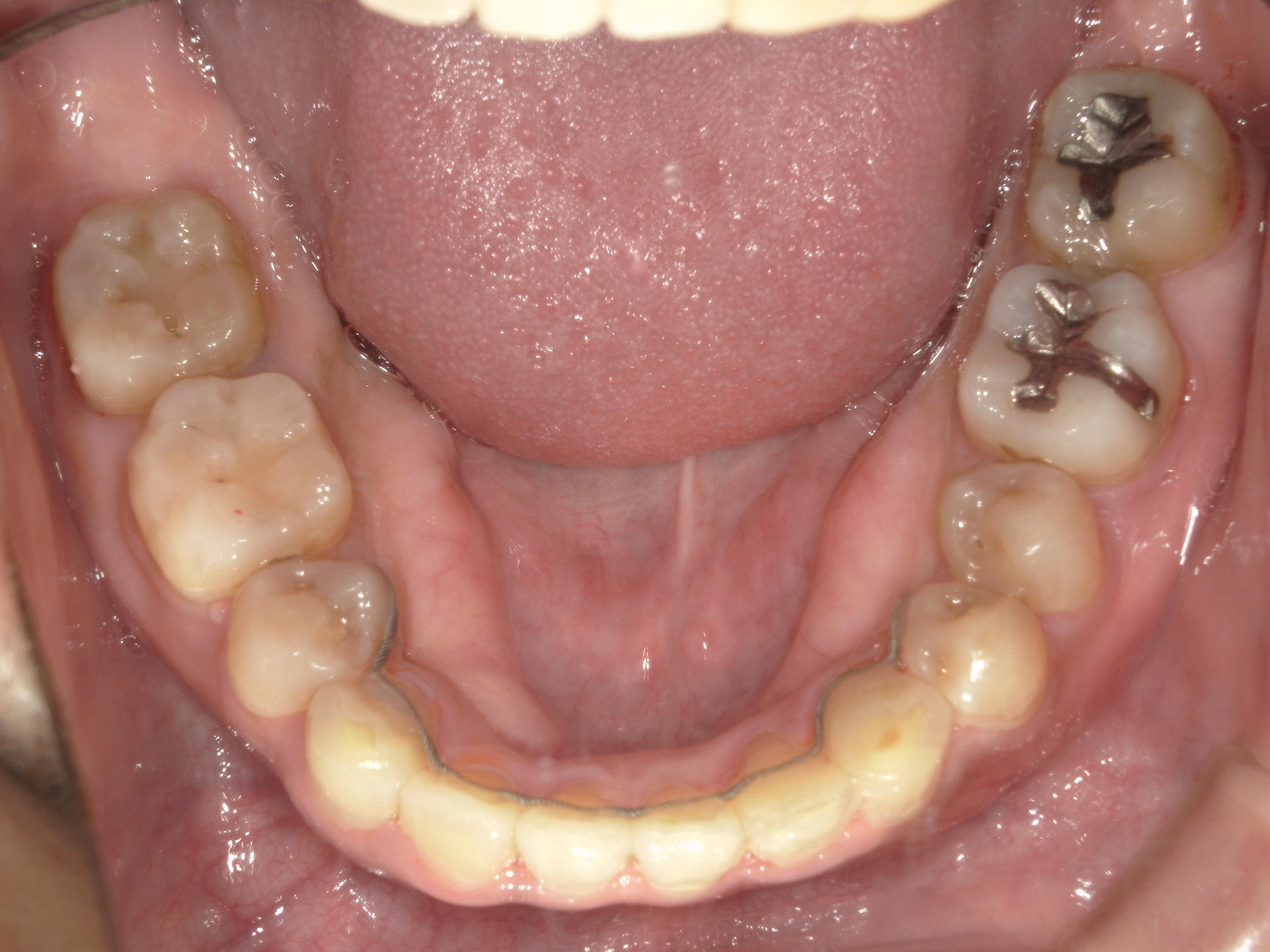 全顎ワイヤー矯正　症例（83）