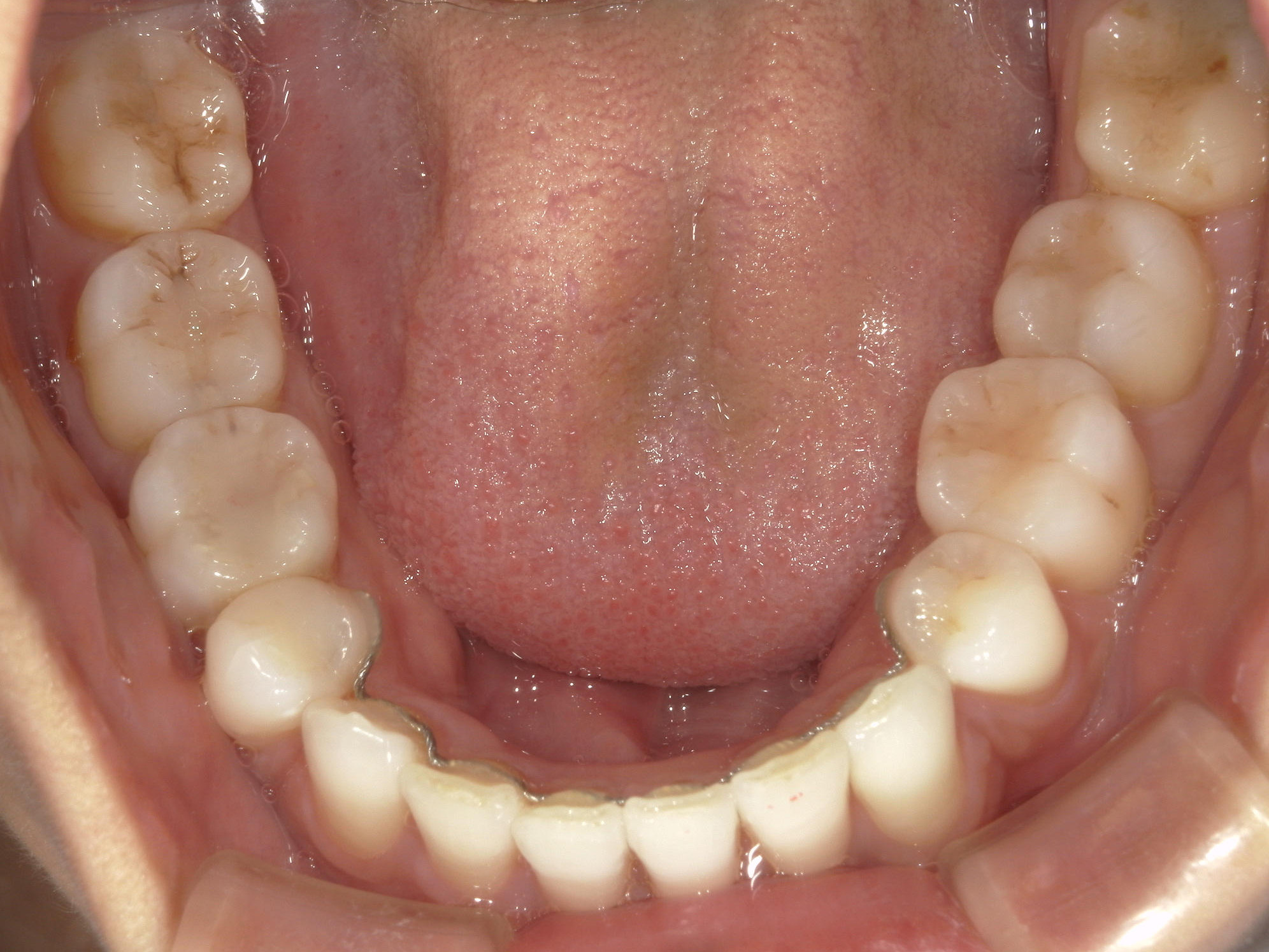 全顎ワイヤー矯正　症例（82）