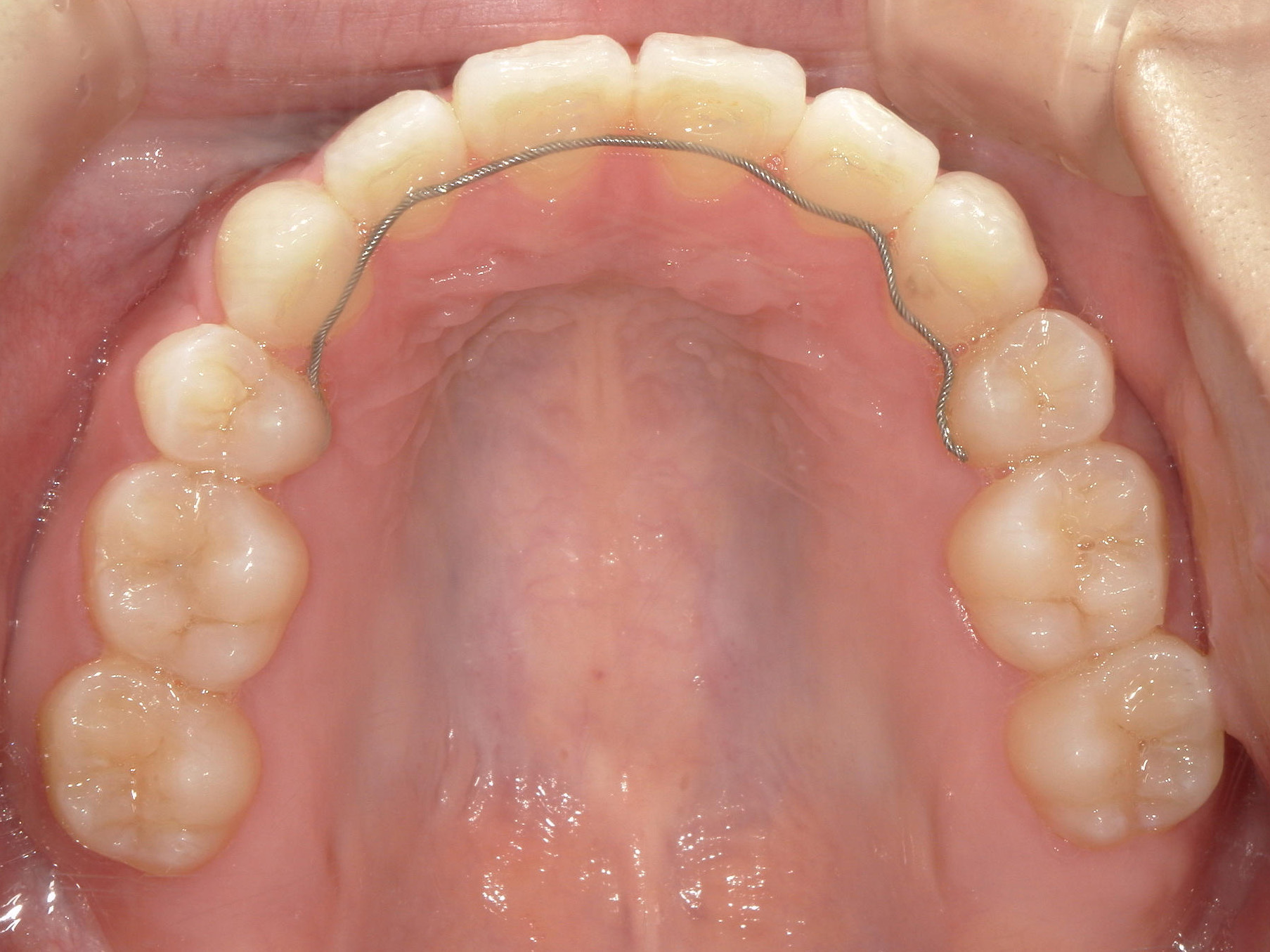 全顎ワイヤー矯正　症例（85）
