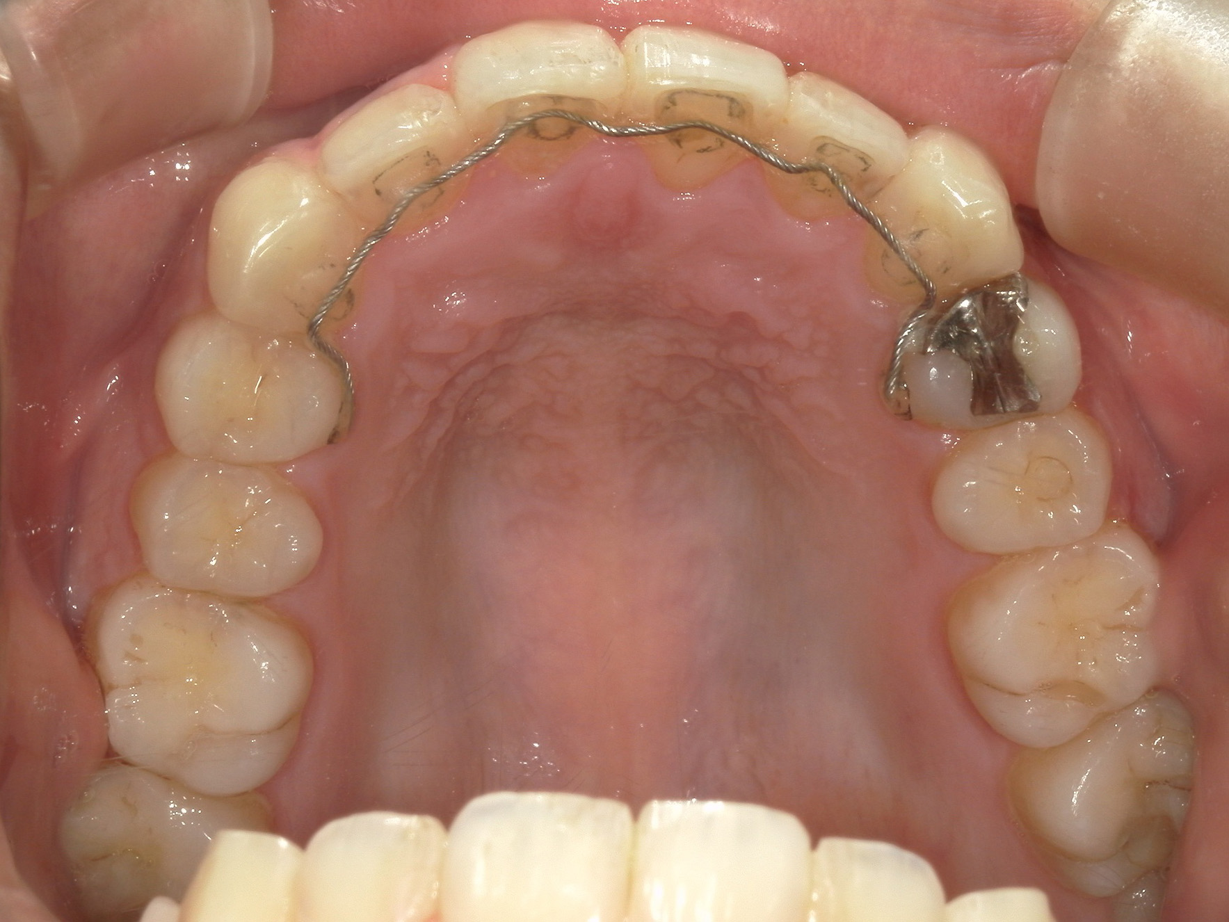 プチワイヤー矯正　症例（65）