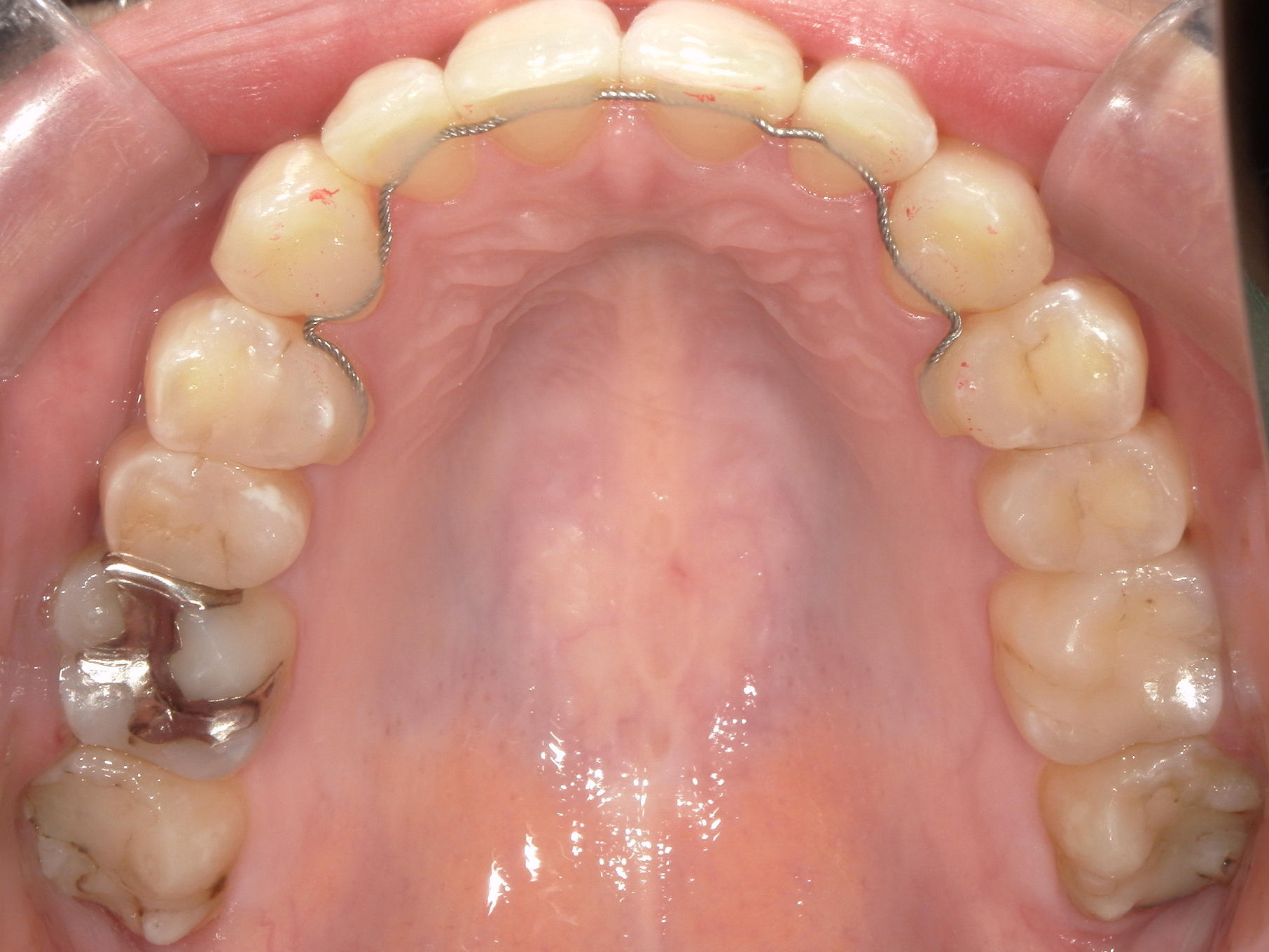 インビザライン(ライト)矯正　症例（35）