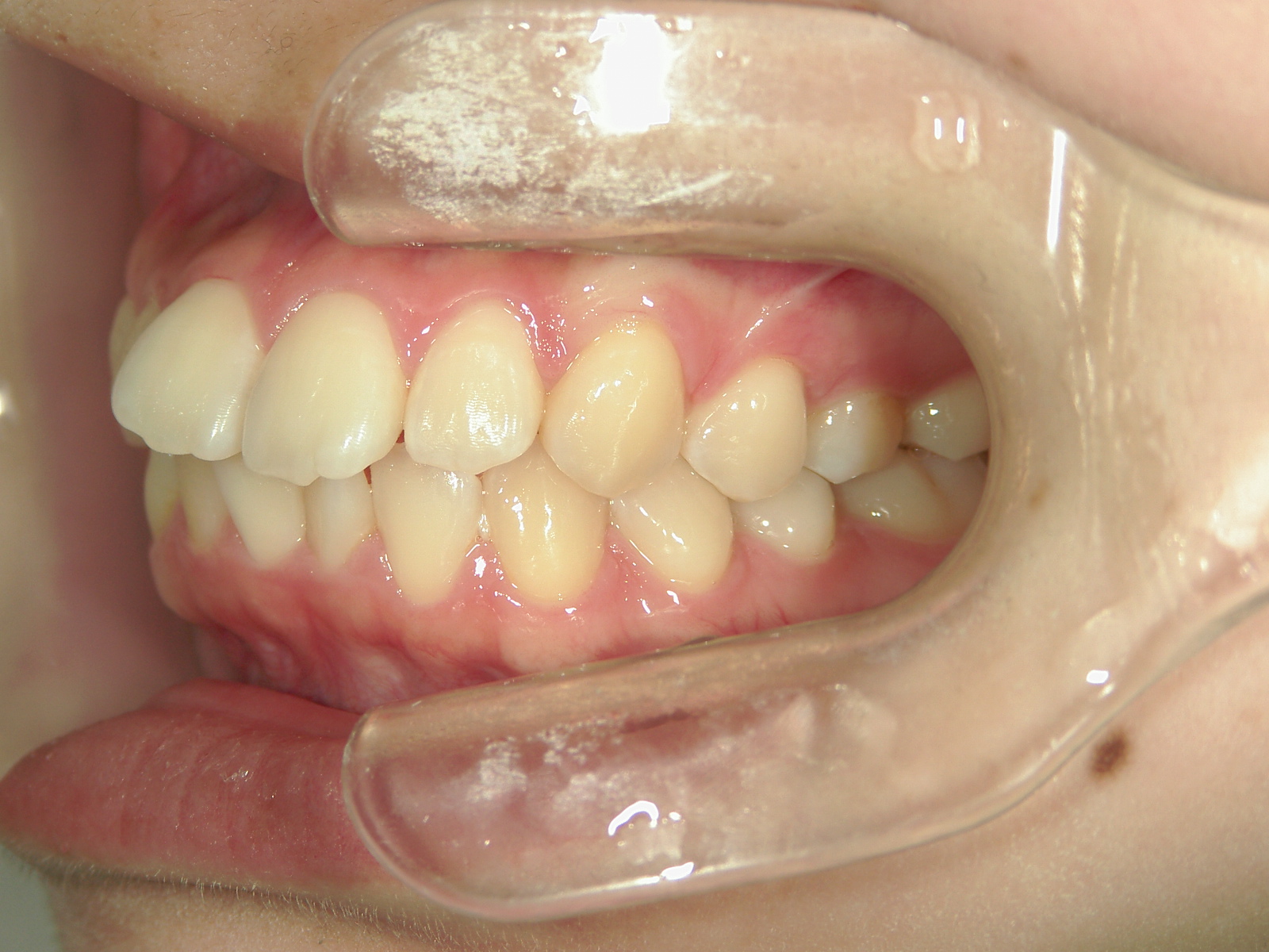 全顎ワイヤー矯正　症例（85）