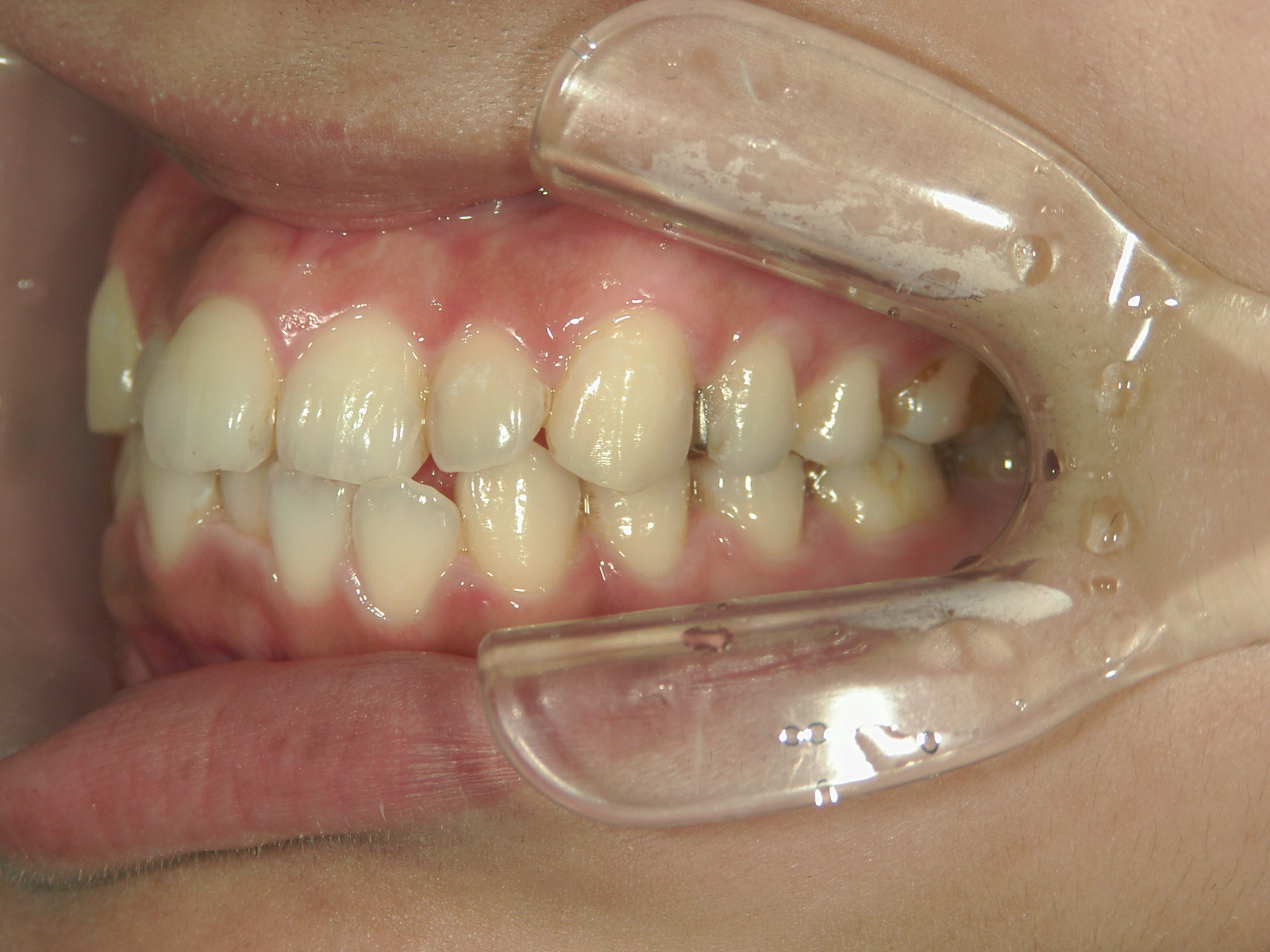 プチワイヤー矯正　症例（65）