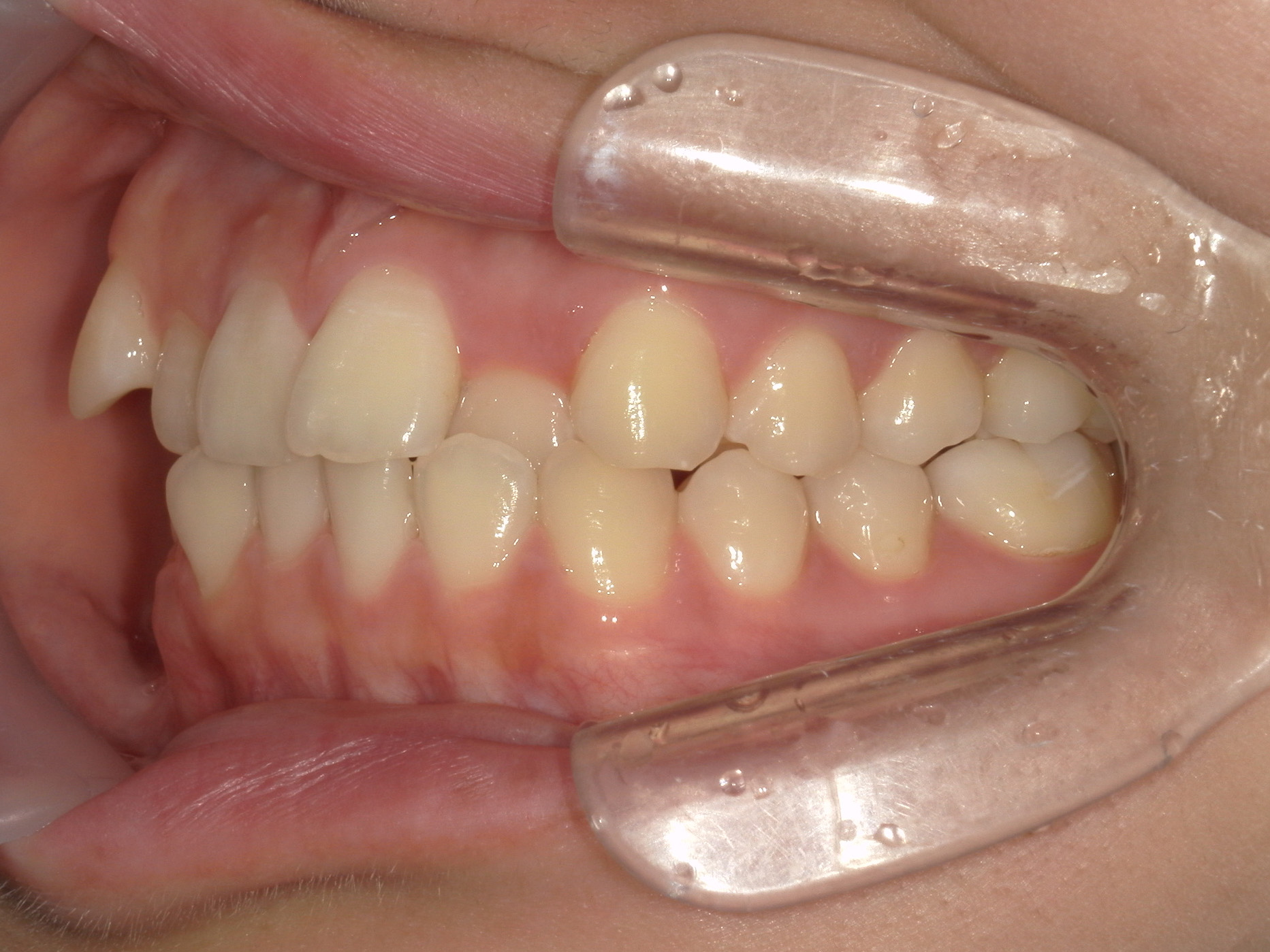 プチワイヤー矯正　症例（66）