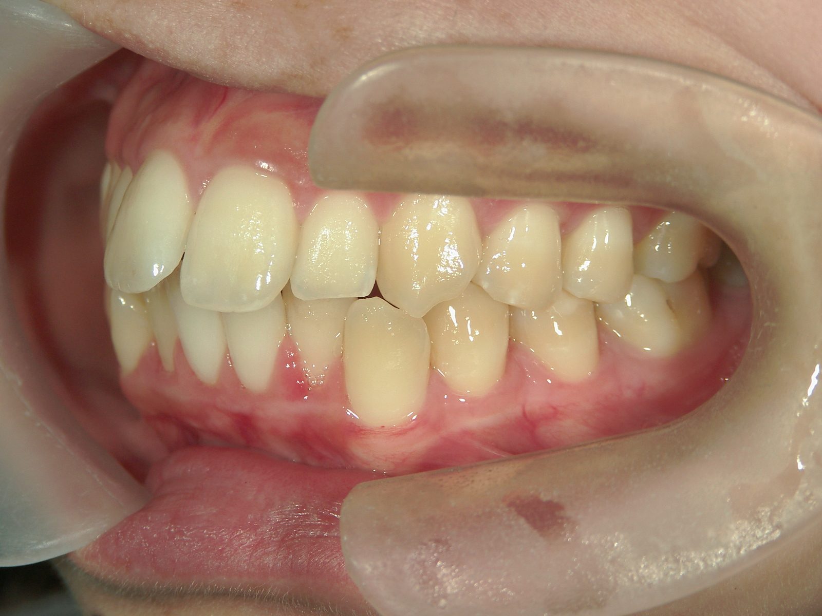 インビザライン(ライト)矯正　症例（35）