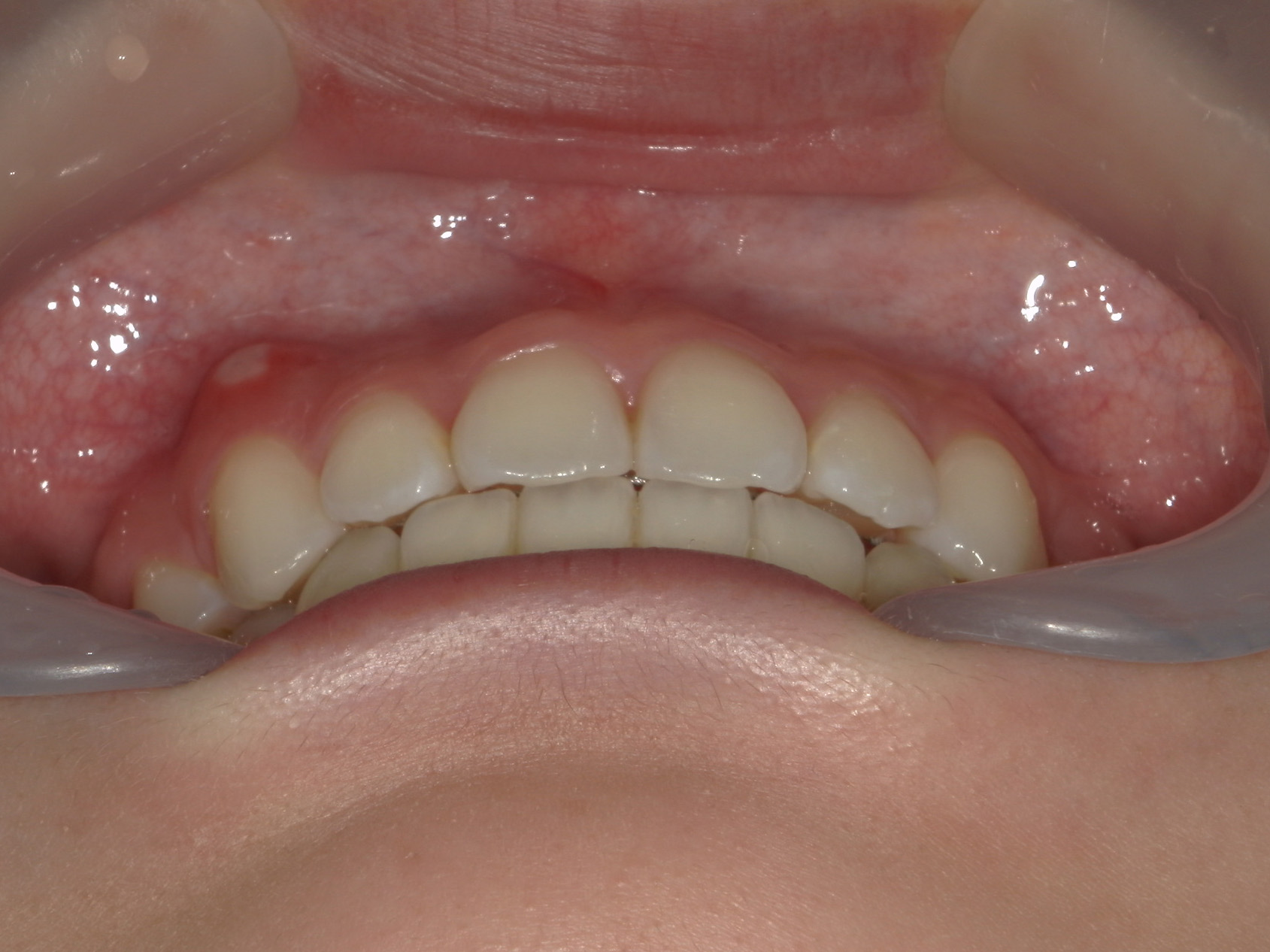 全顎ワイヤー矯正　症例（85）