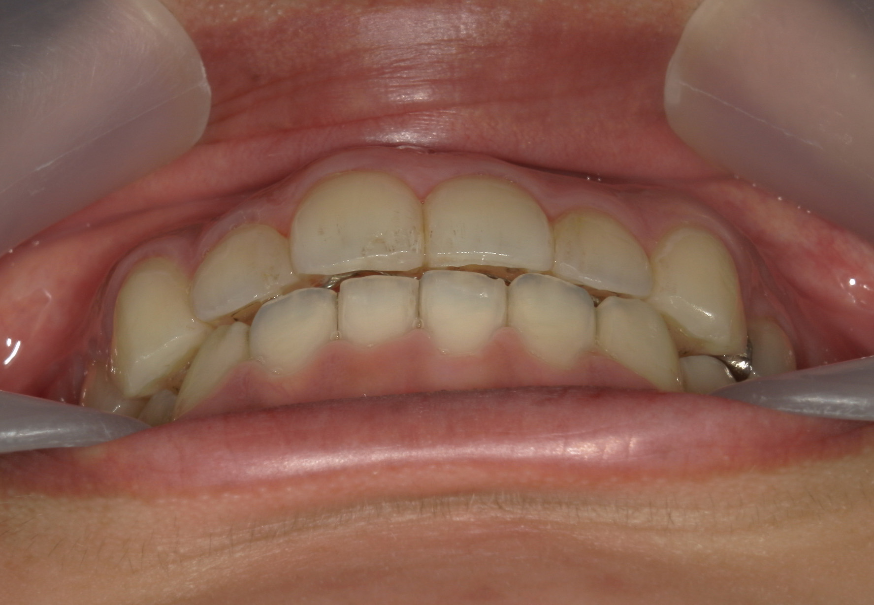 プチワイヤー矯正　症例（65）