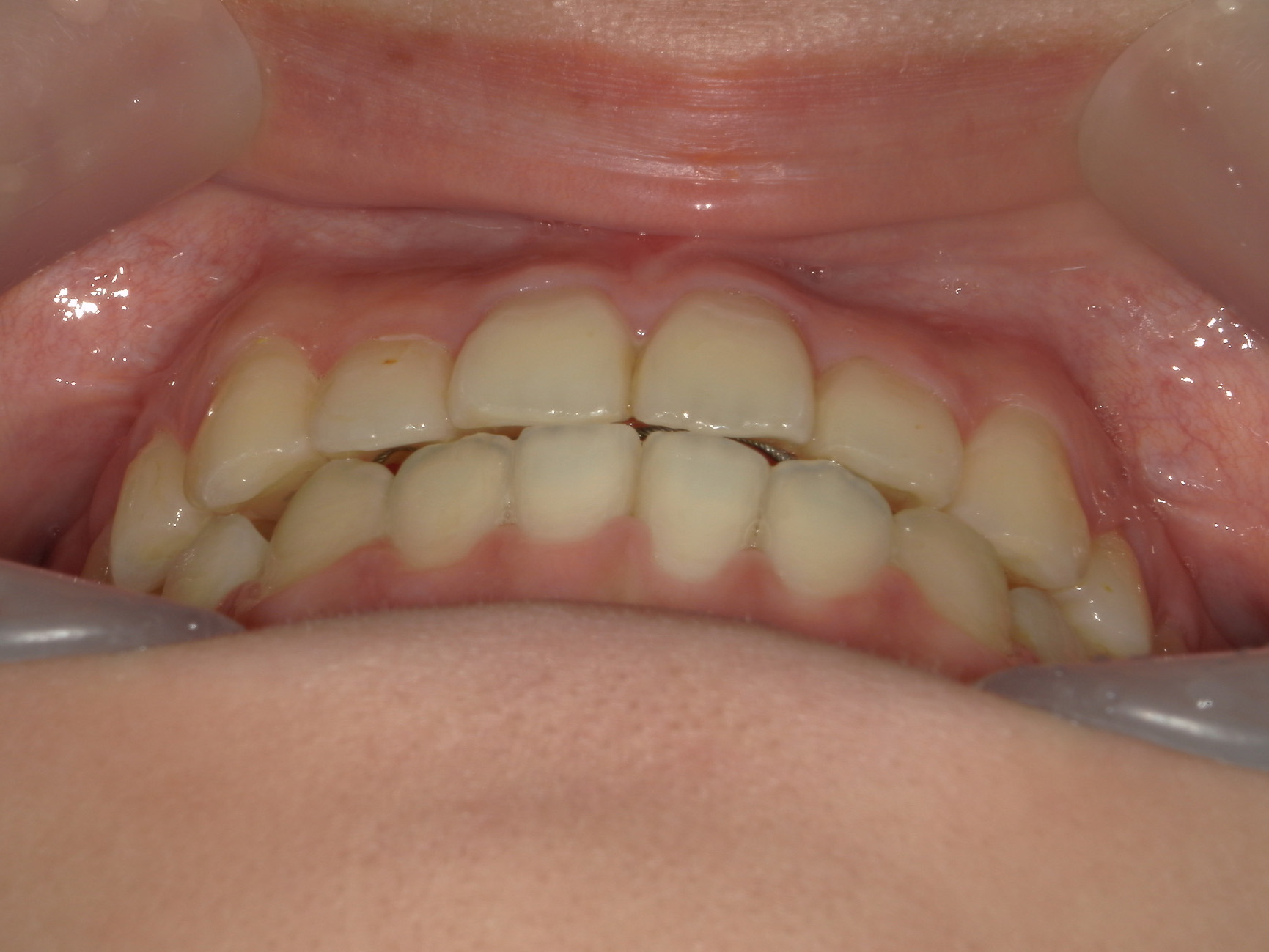 プチワイヤー矯正　症例（66）