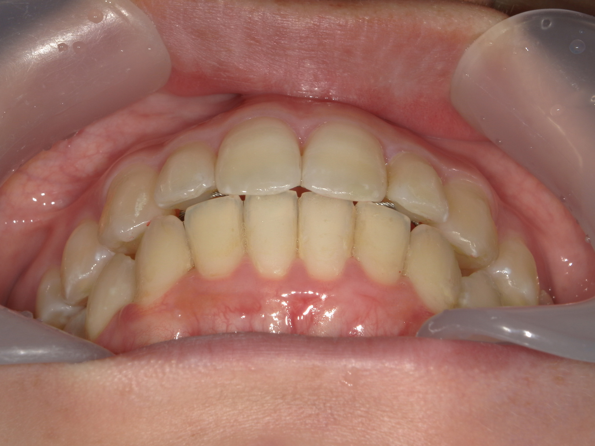 インビザライン(ライト)矯正　症例（35）