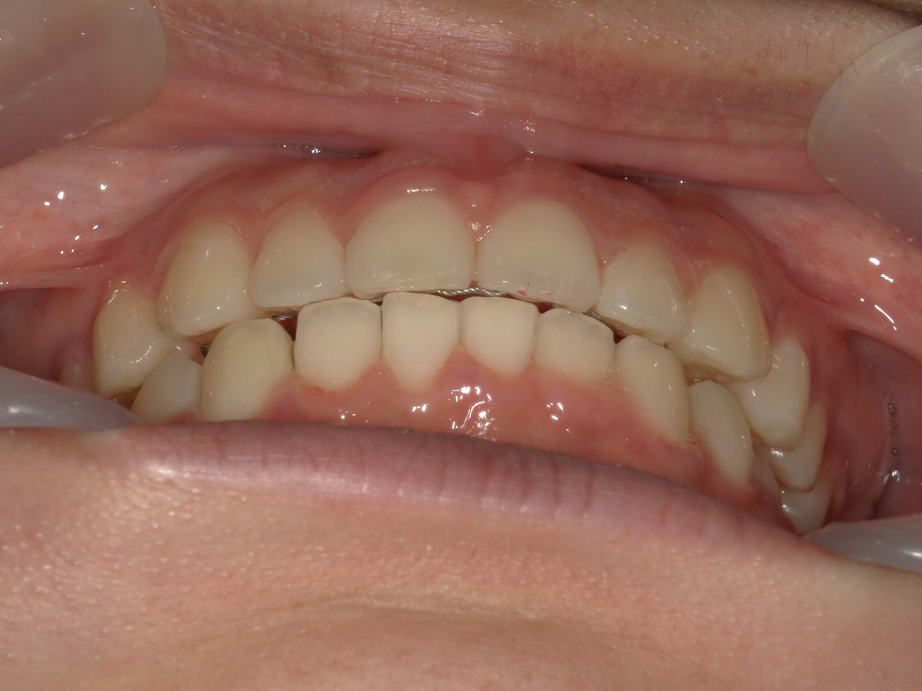 プチワイヤー矯正　症例（64）