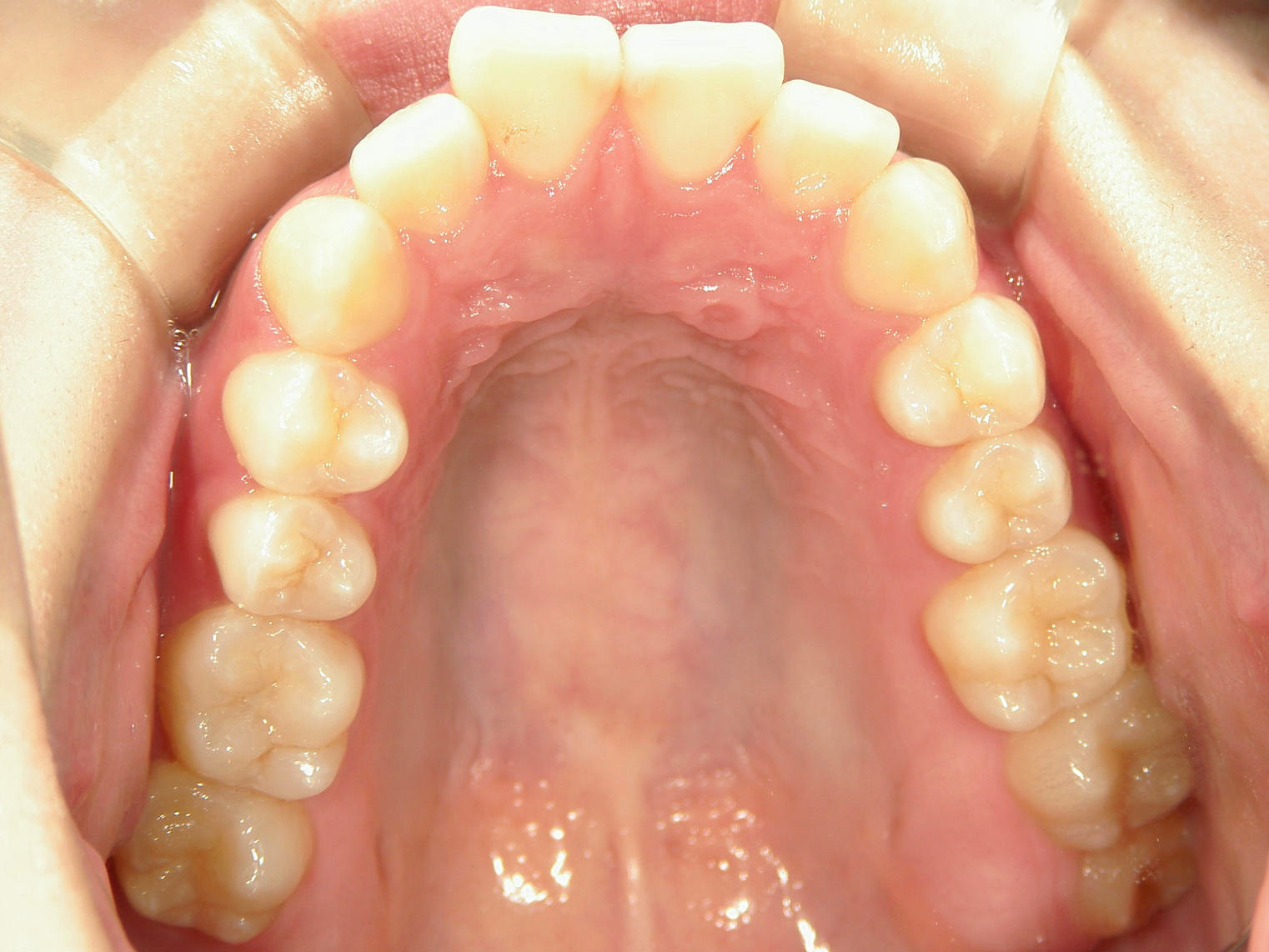 全顎ワイヤー矯正　症例（85）