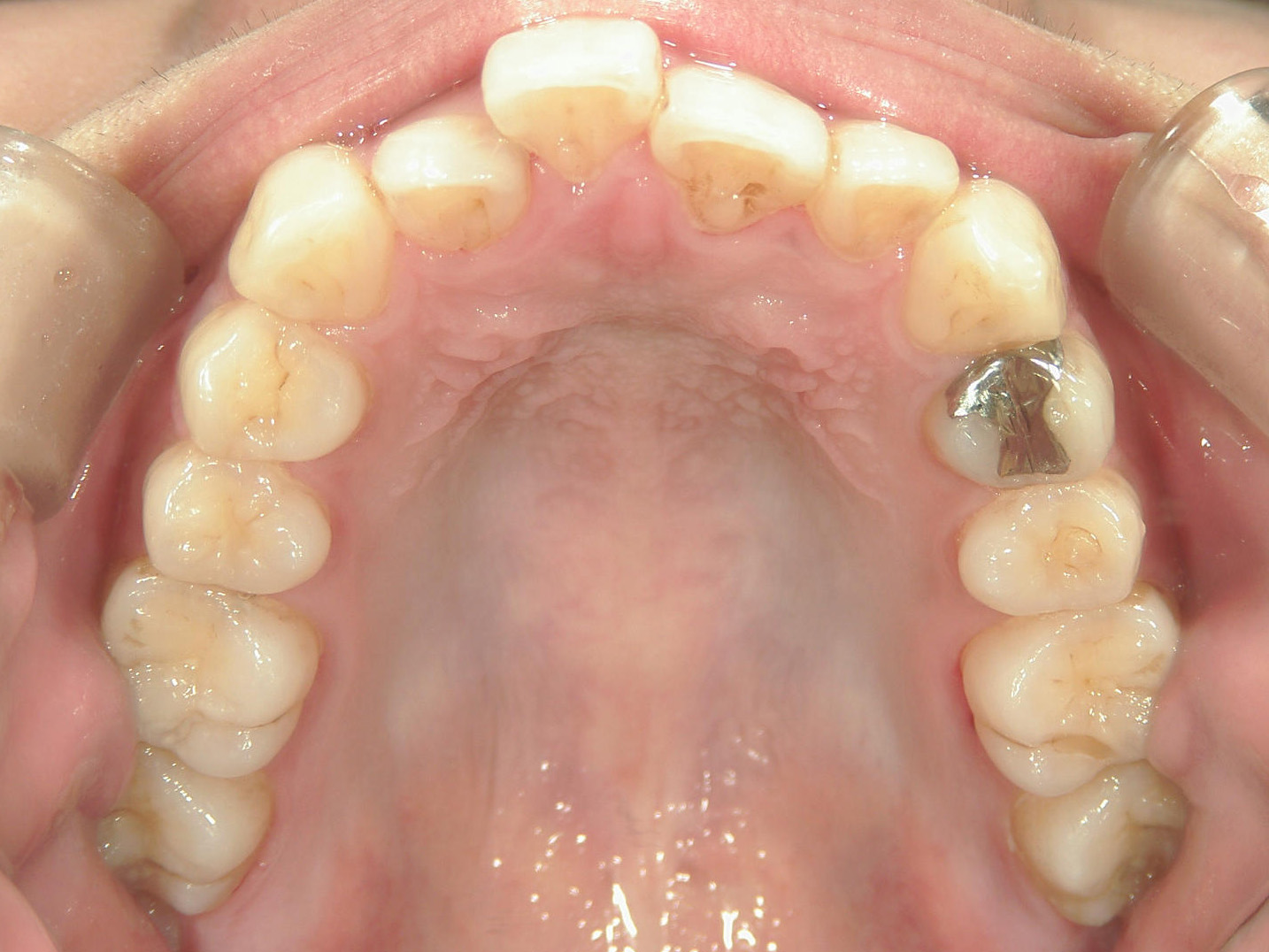 プチワイヤー矯正　症例（65）