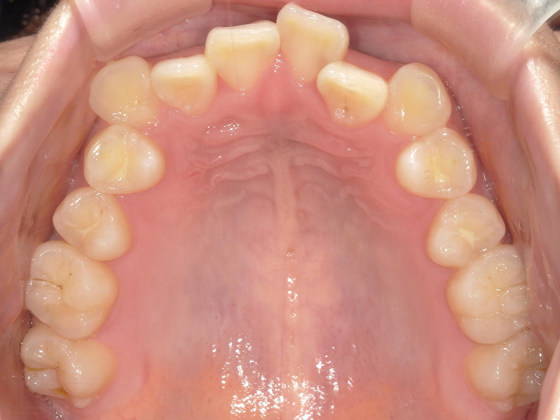 プチワイヤー矯正　症例（66）