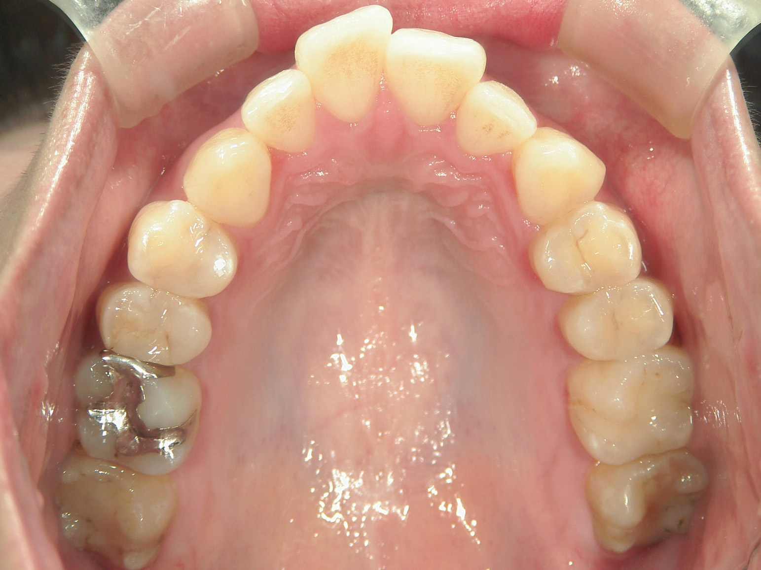 インビザライン(ライト)矯正　症例（35）