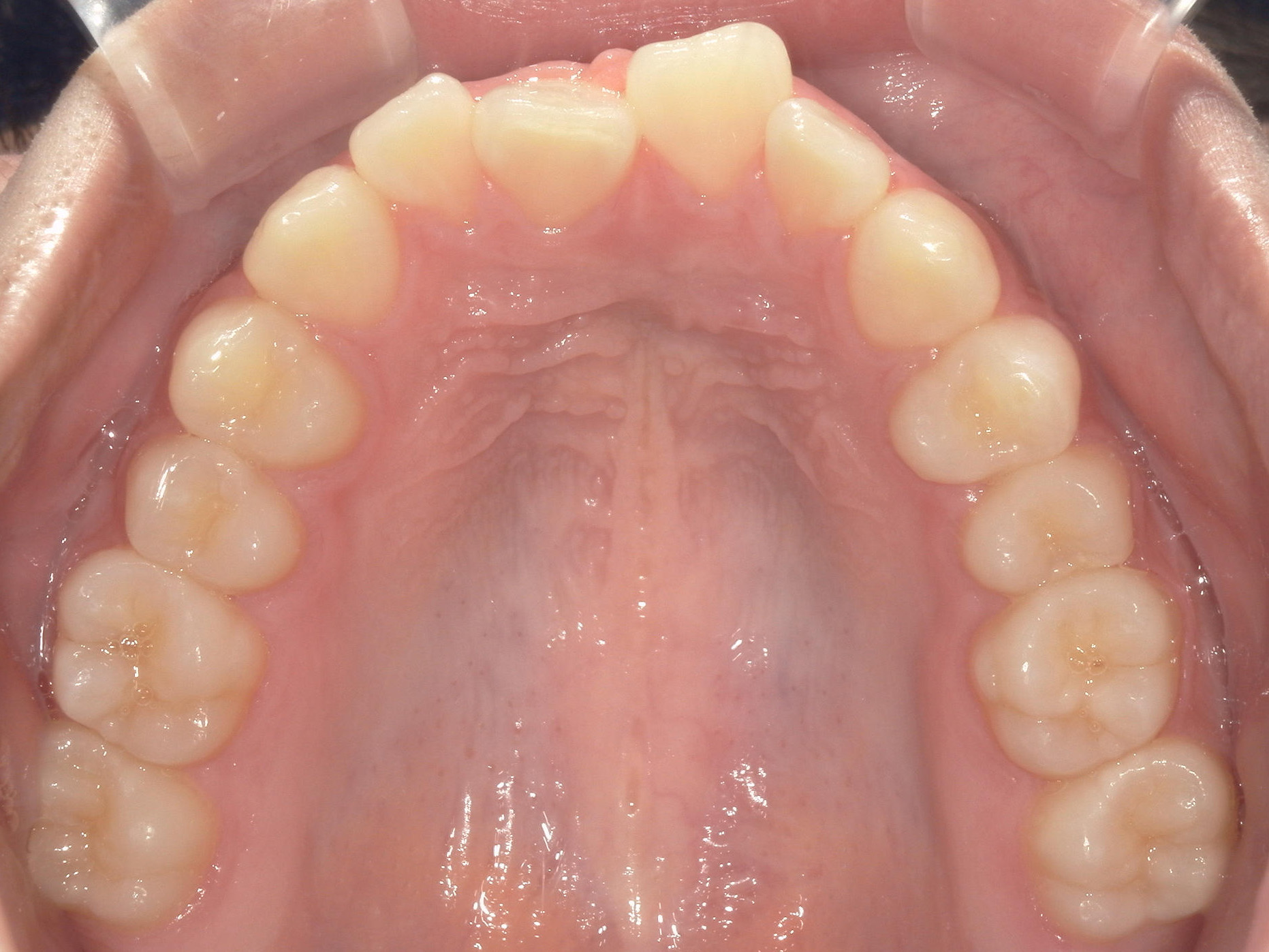プチワイヤー矯正　症例（64）