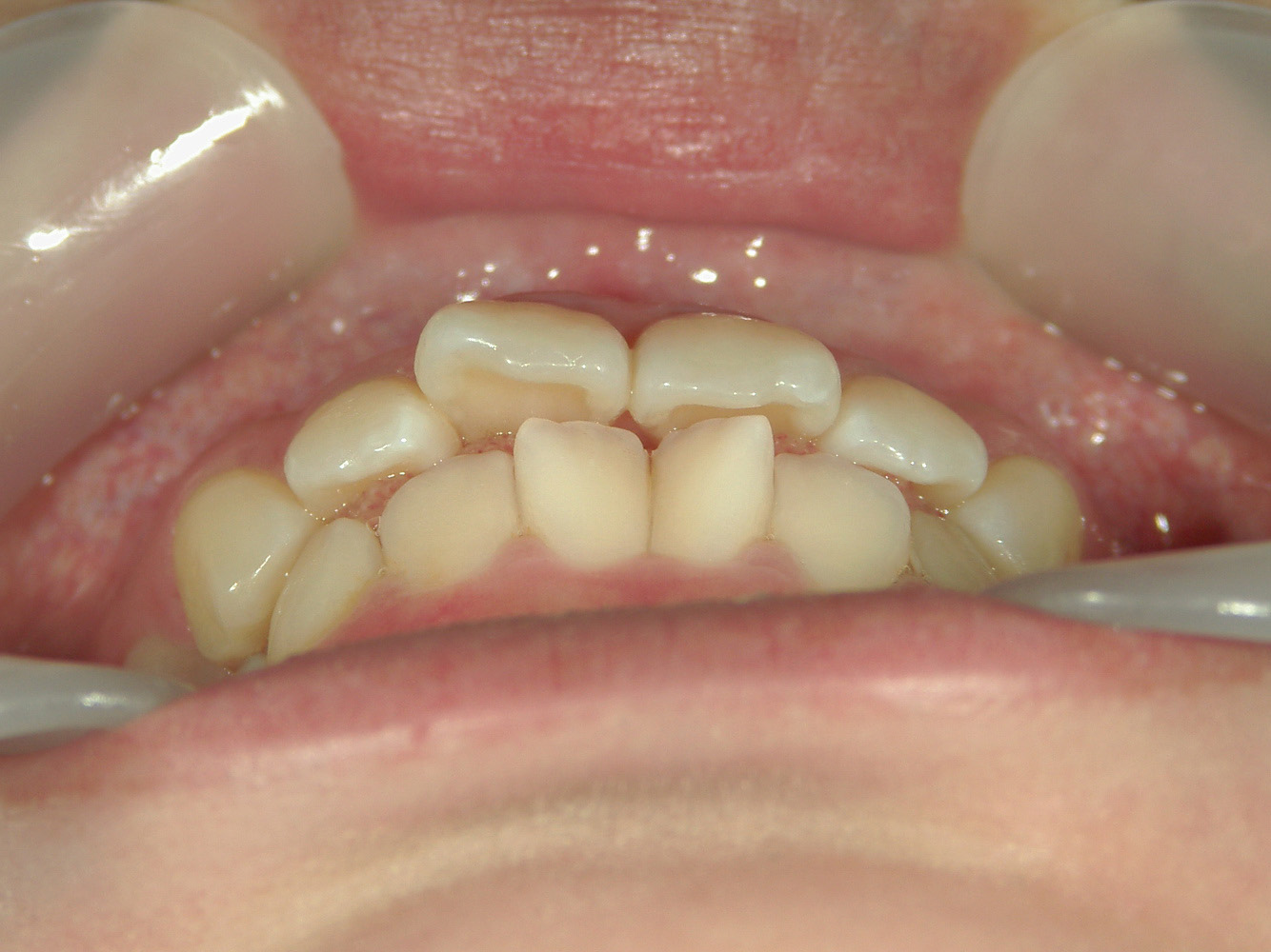 全顎ワイヤー矯正　症例（85）