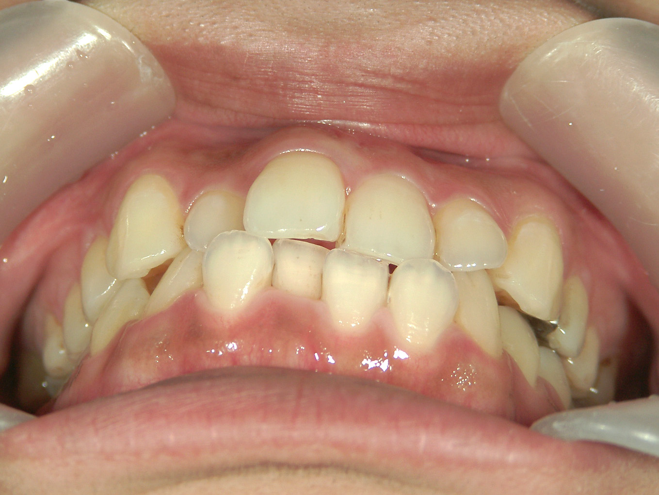 プチワイヤー矯正　症例（65）