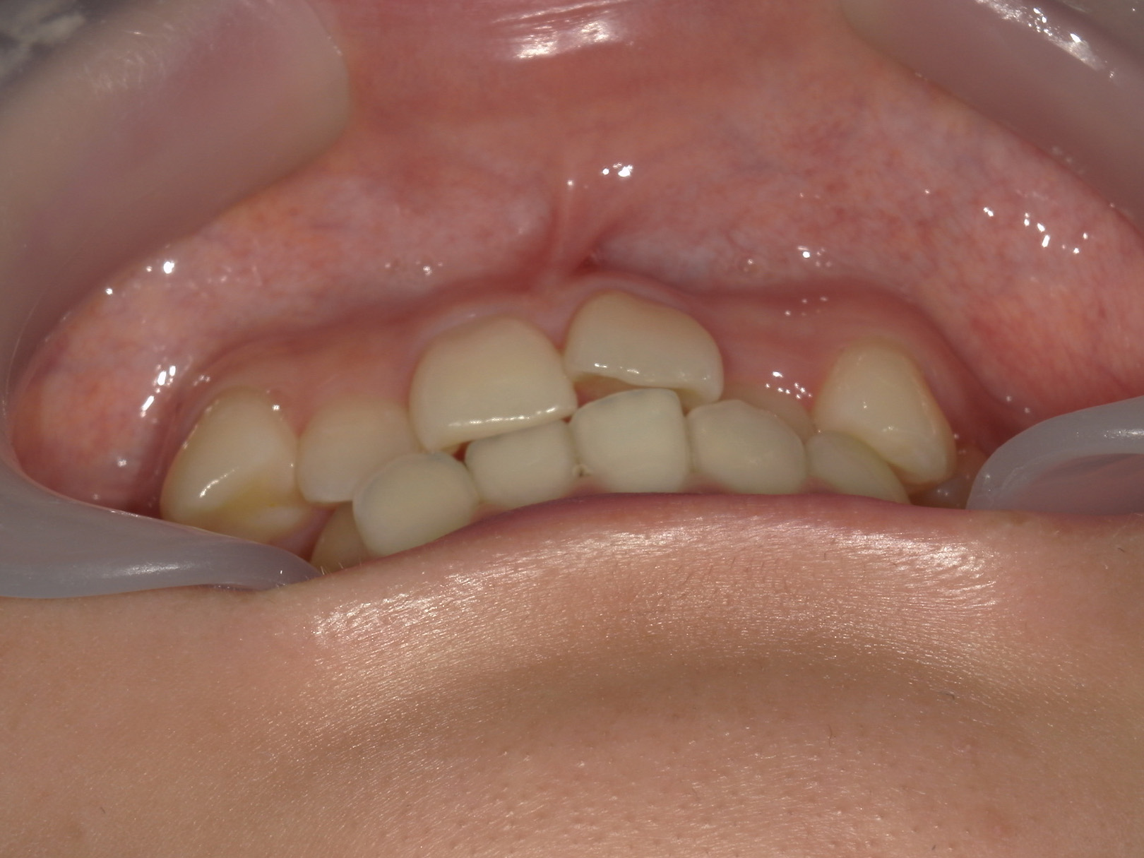 プチワイヤー矯正　症例（66）