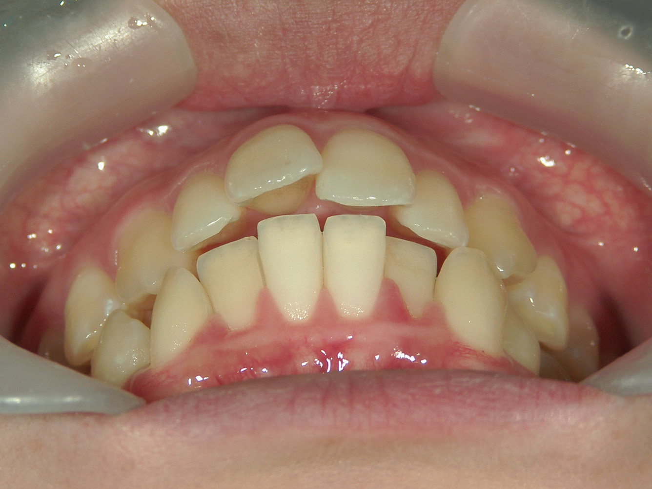 インビザライン(ライト)矯正　症例（35）