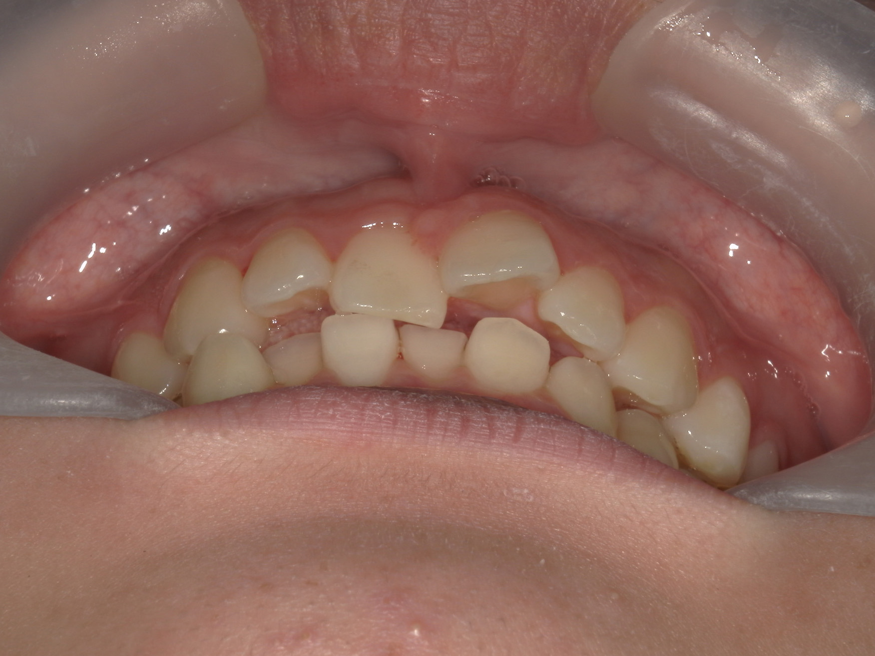 プチワイヤー矯正　症例（64）