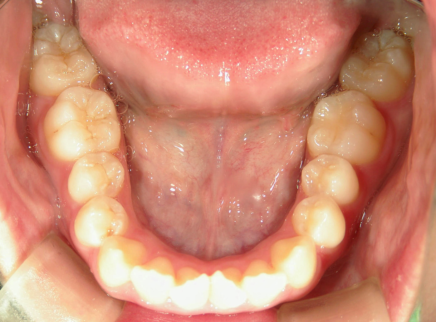 全顎ワイヤー矯正　症例（85）