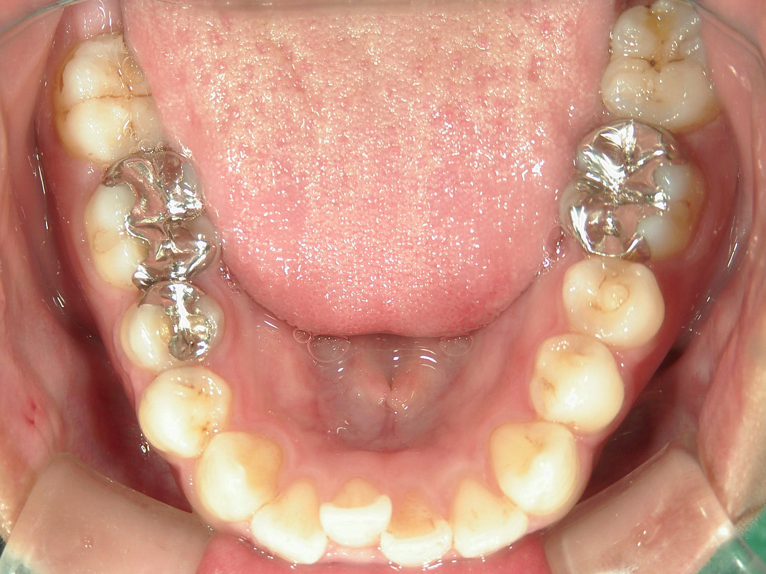 プチワイヤー矯正　症例（65）