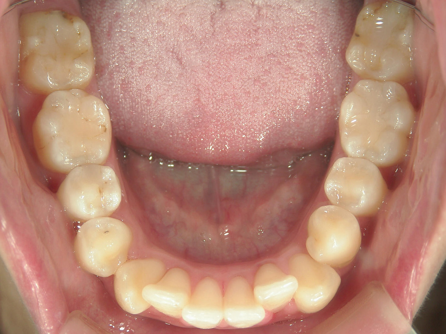 インビザライン(ライト)矯正　症例（35）