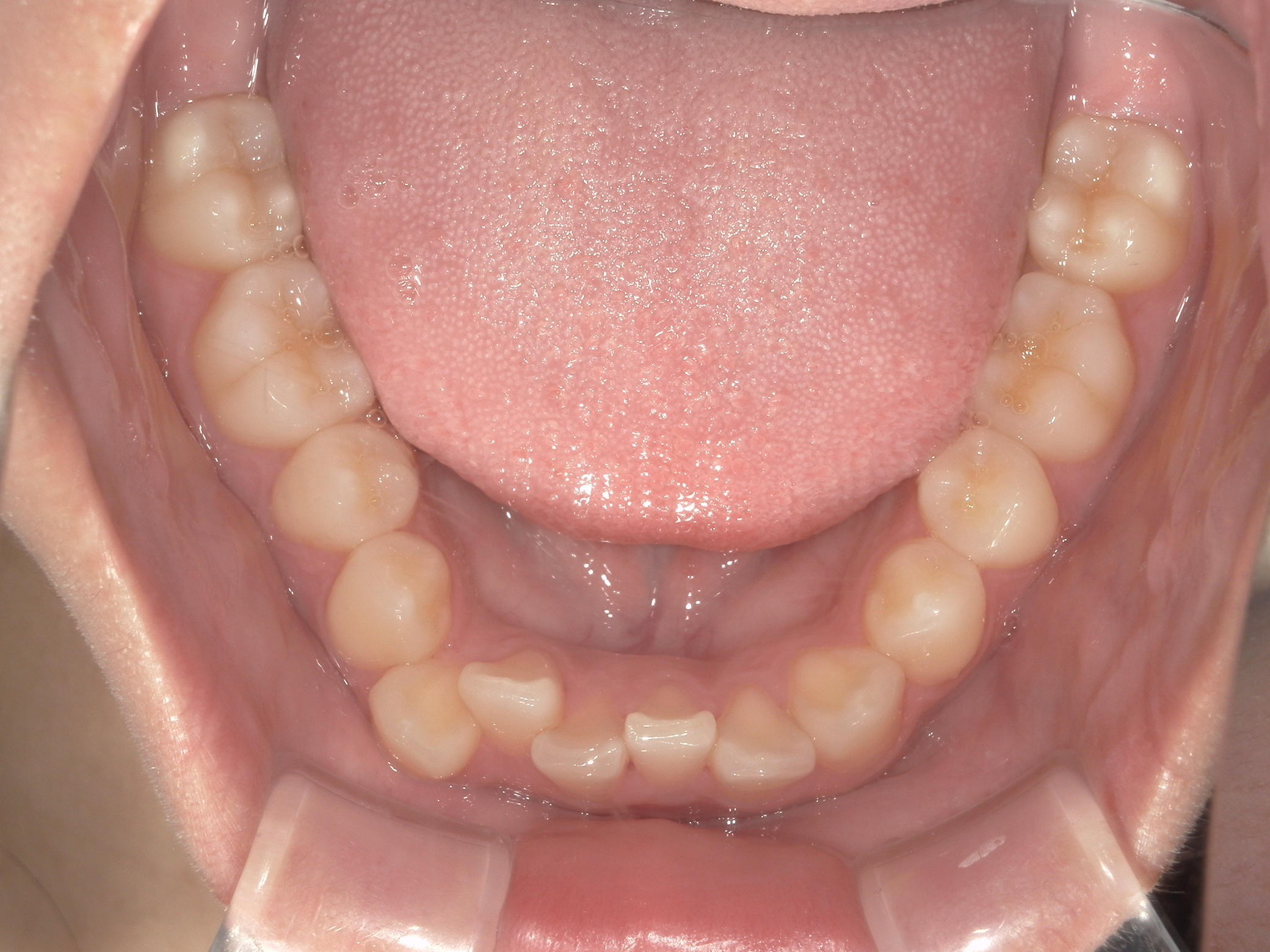 プチワイヤー矯正　症例（64）