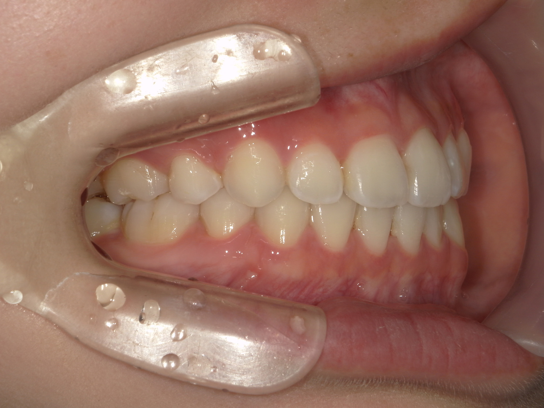 全顎ワイヤー矯正　症例（85）