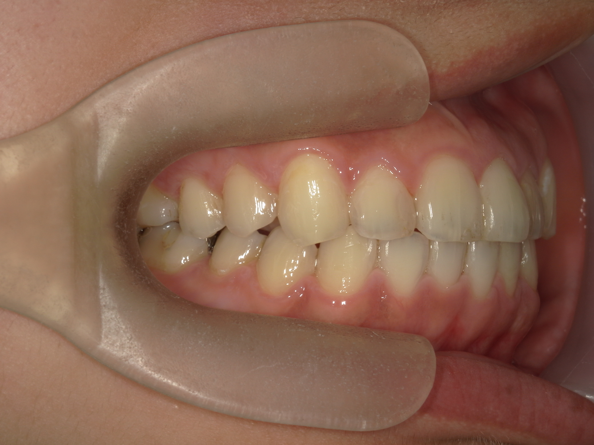 プチワイヤー矯正　症例（65）