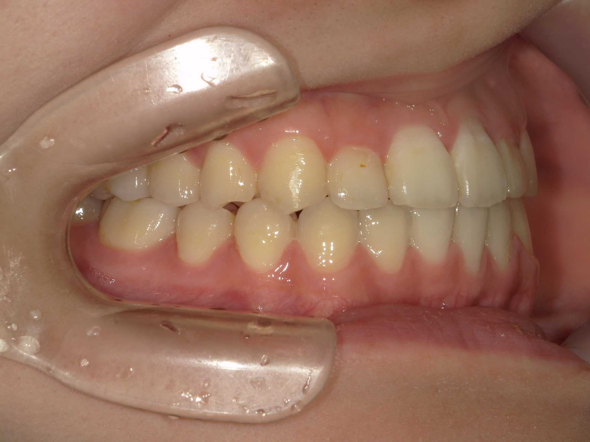 プチワイヤー矯正　症例（66）