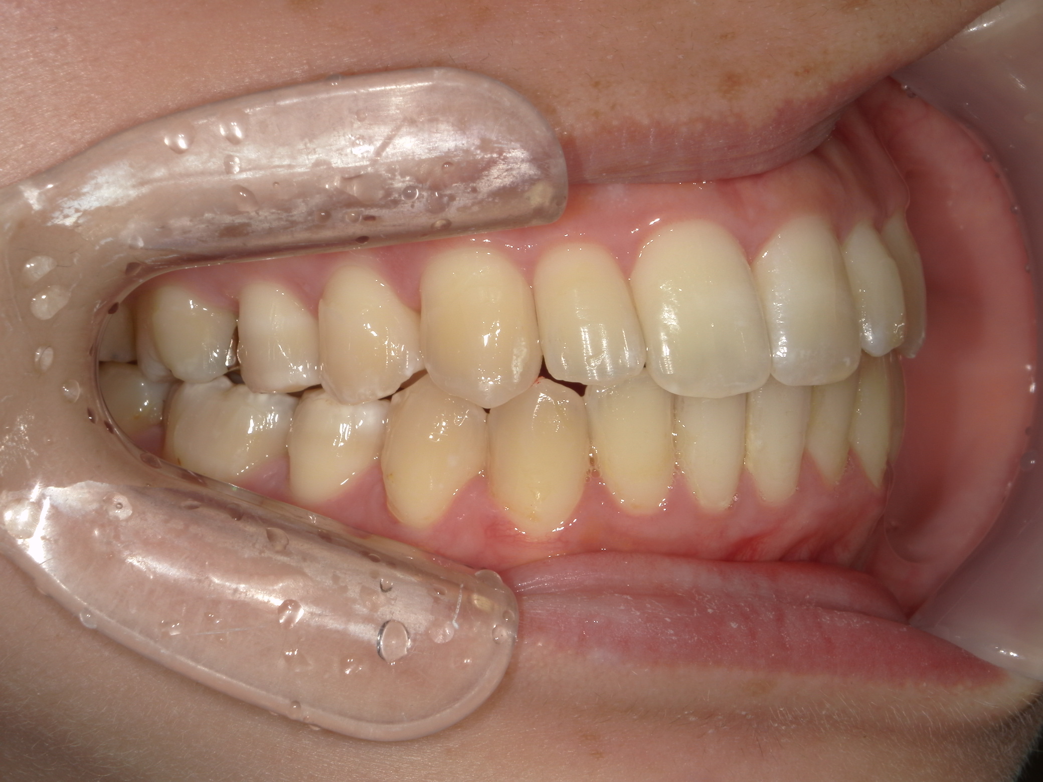 インビザライン(ライト)矯正　症例（35）