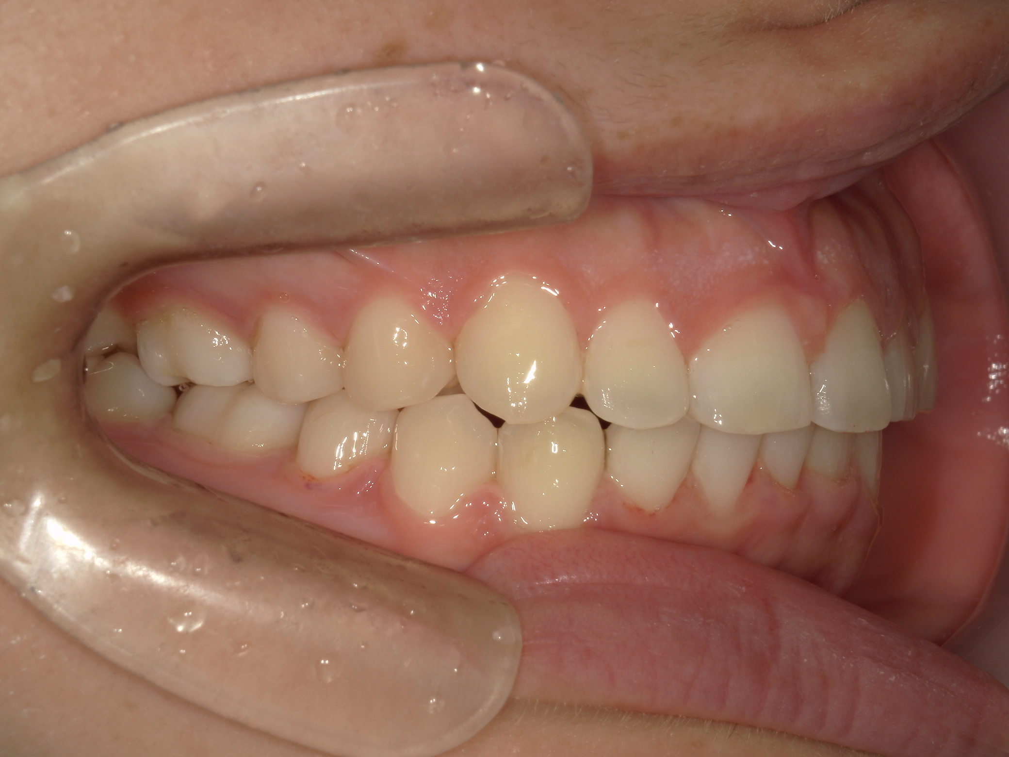 プチワイヤー矯正　症例（64）