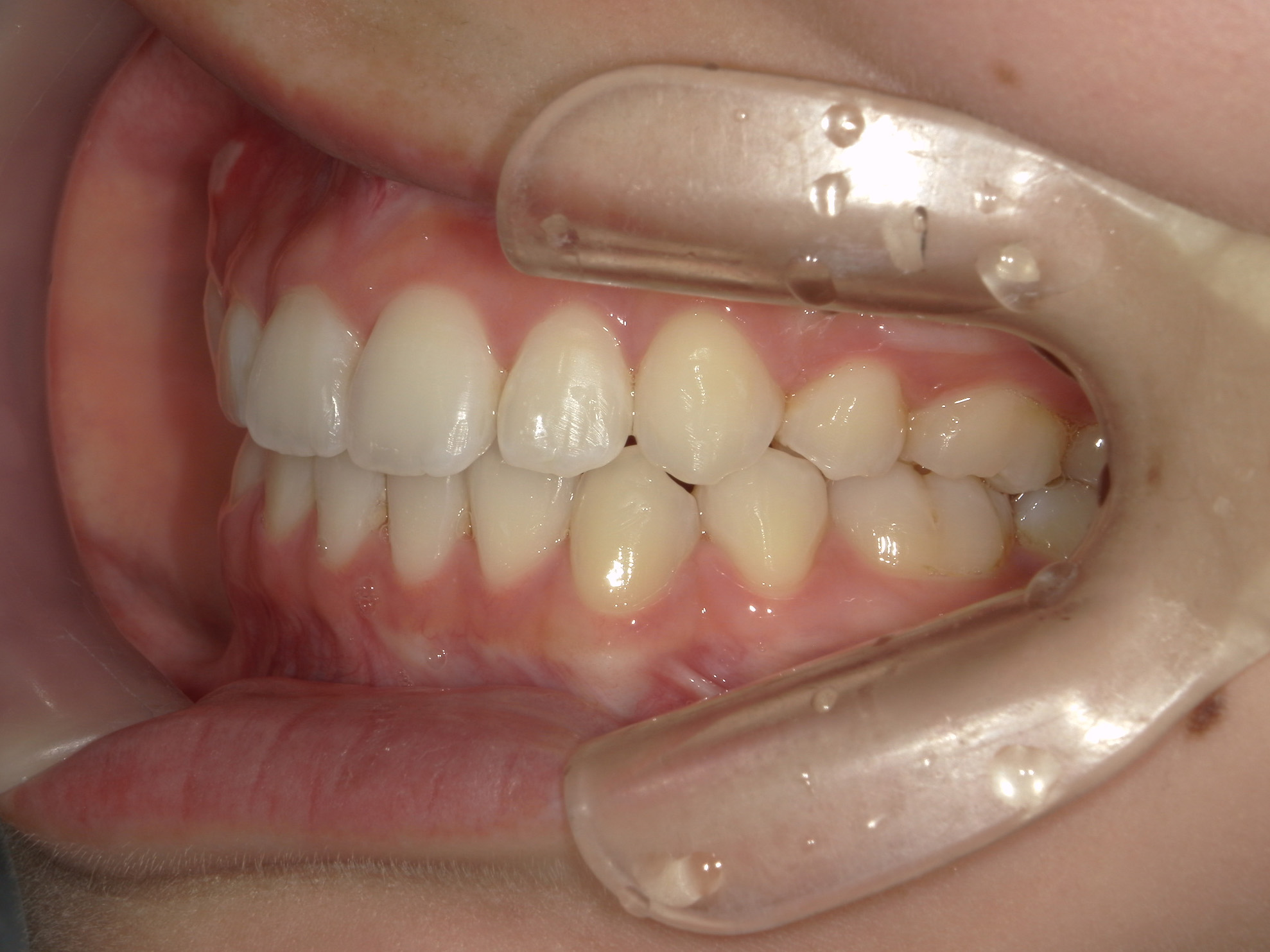 全顎ワイヤー矯正　症例（85）