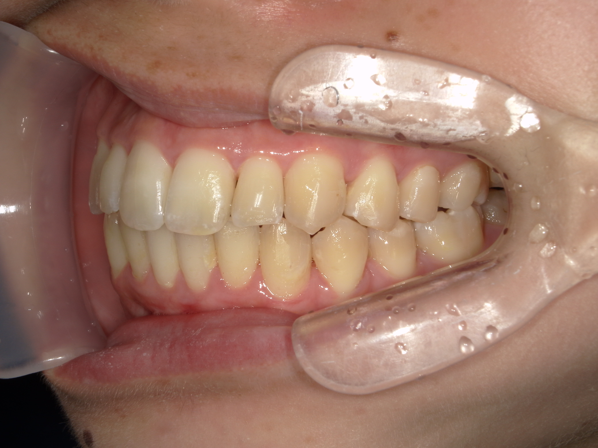 インビザライン(ライト)矯正　症例（35）