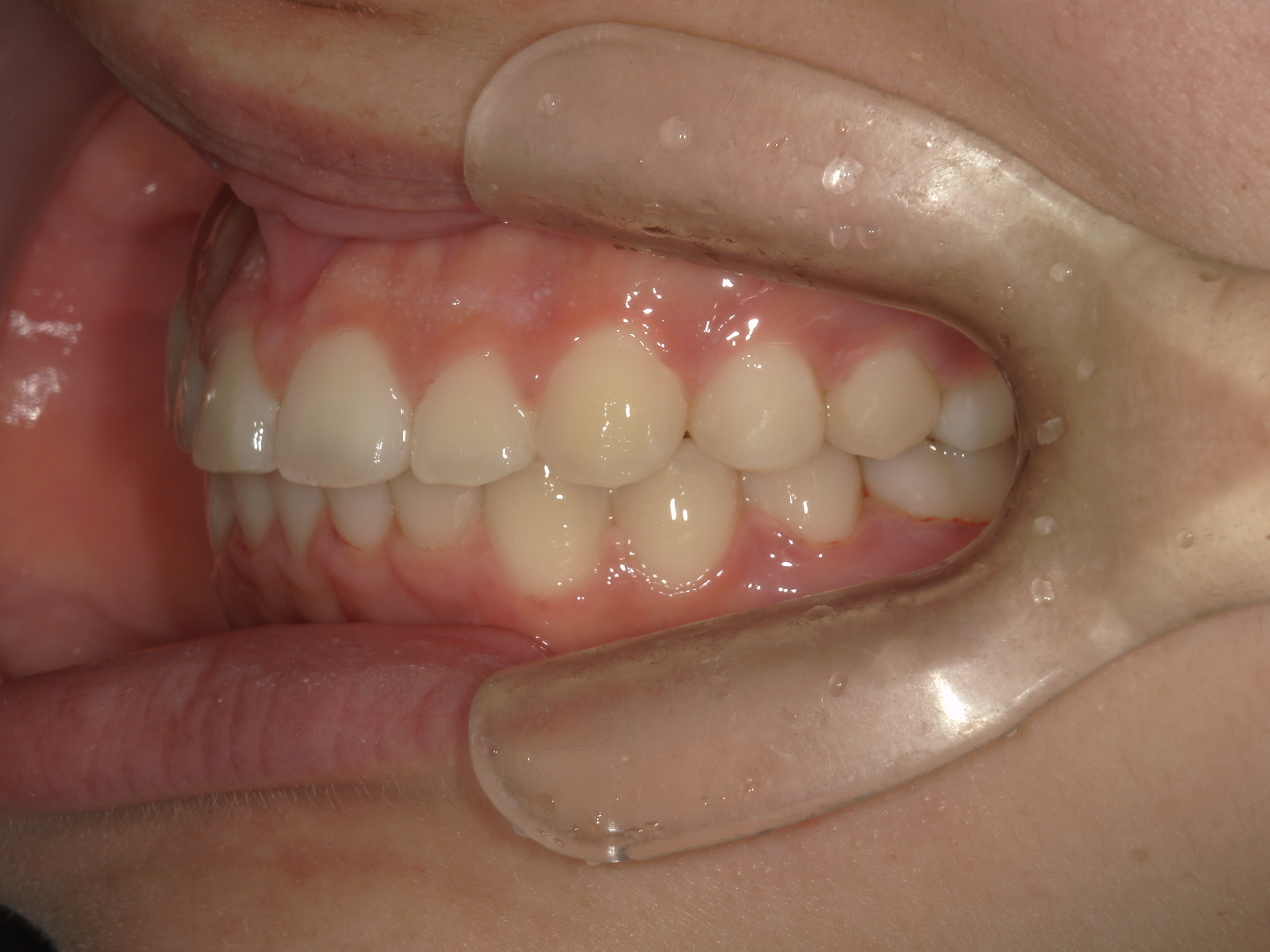 プチワイヤー矯正　症例（64）